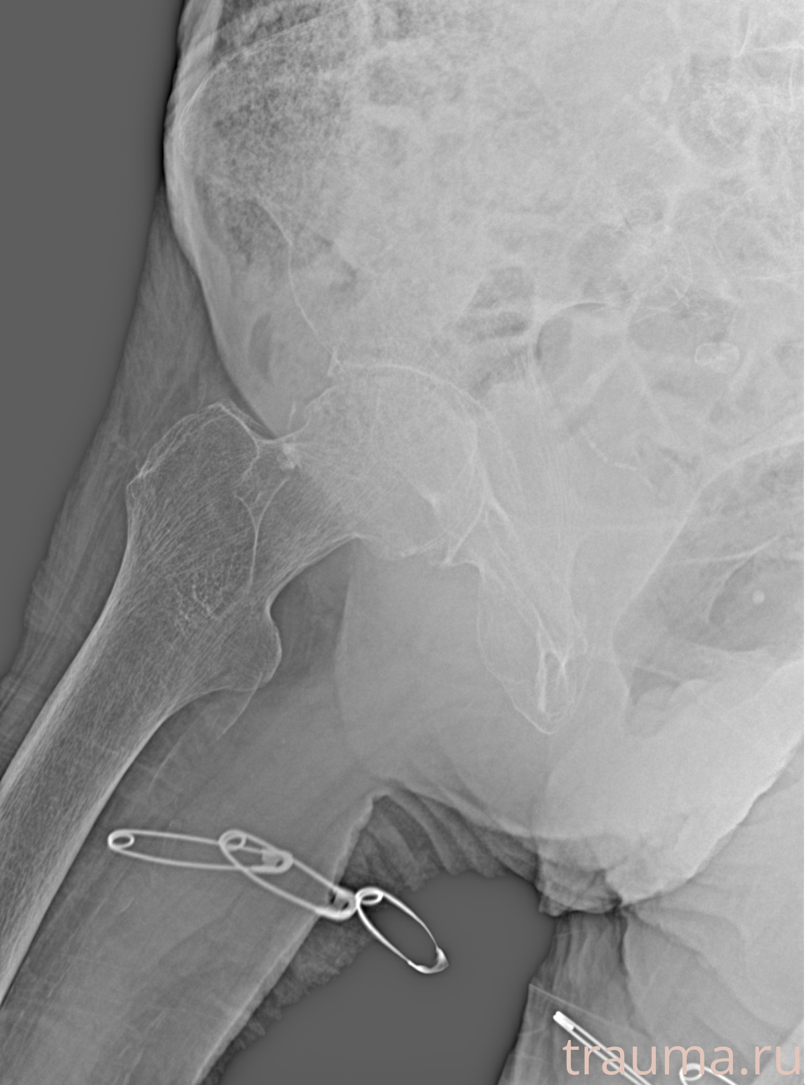 Рентген на дому: по вашему адресу приезжает врач-рентгенолог, травматолог-ортопед с мобильным рентгеновским аппаратом, проводит диагностику травмы или заболевания, делает необходимые рентгенограммы, дает рекомендации по дальнейшему лечению. Получить качественные снимки в домашних условиях возможно благодаря уникальной методике, разработанной МосРентген Центром для института  Склифосовского