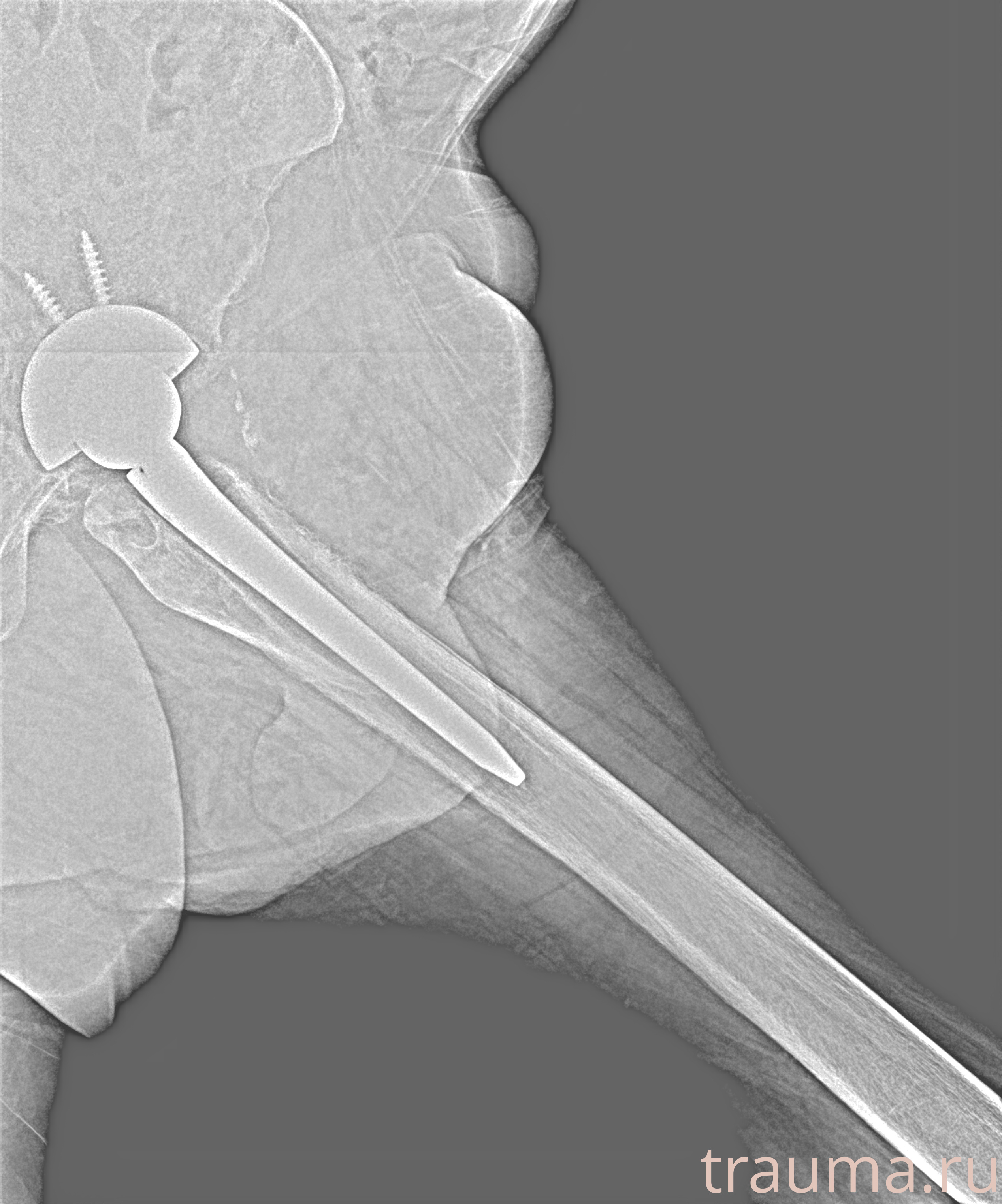 Рентген на дому: по вашему адресу приезжает врач-рентгенолог, травматолог-ортопед с мобильным рентгеновским аппаратом, проводит диагностику травмы или заболевания, делает необходимые рентгенограммы, дает рекомендации по дальнейшему лечению. Получить качественные снимки в домашних условиях возможно благодаря уникальной методике, разработанной МосРентген Центром для института  Склифосовского