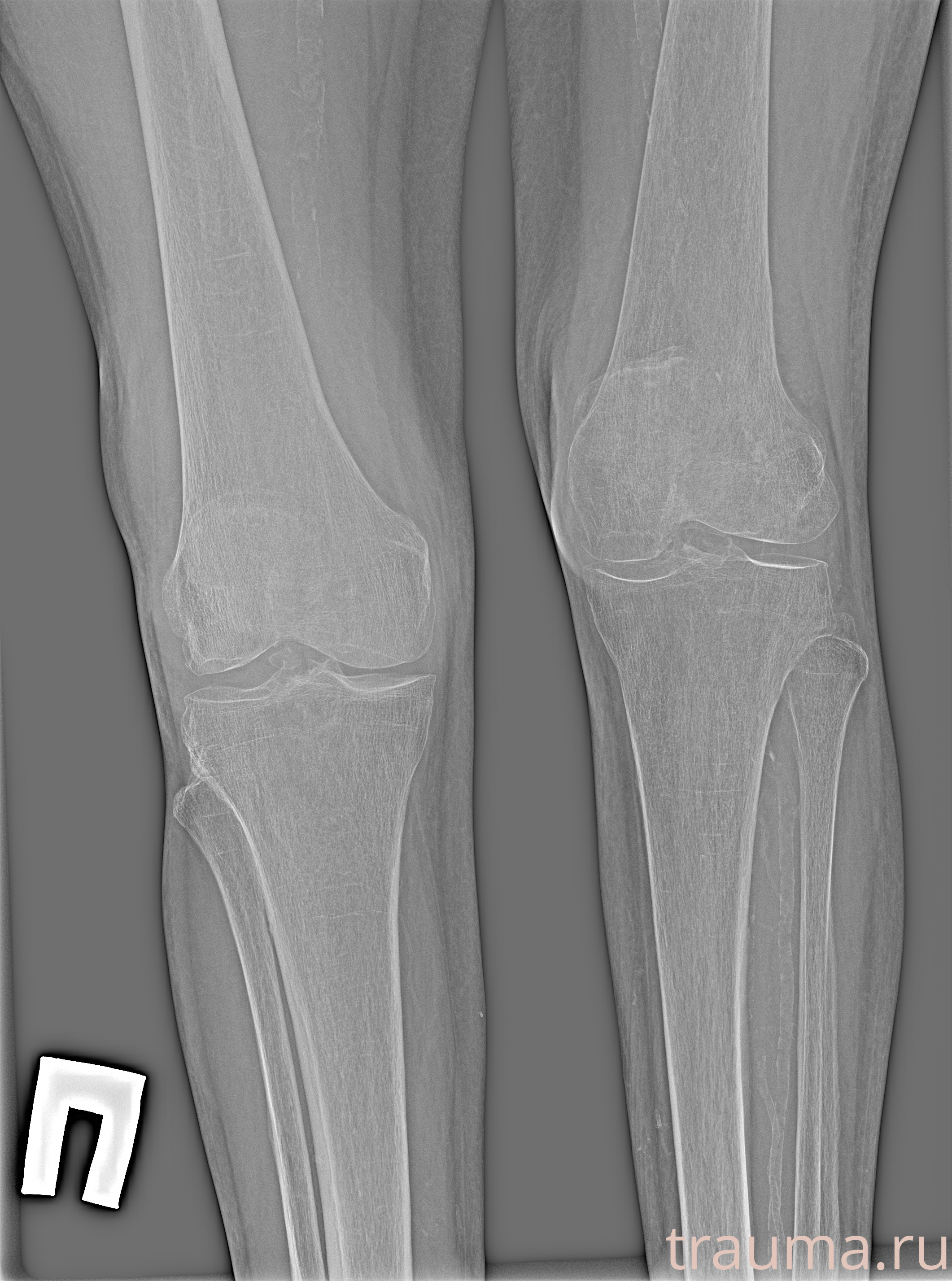 Рентген на дому: по вашему адресу приезжает врач-рентгенолог, травматолог-ортопед с мобильным рентгеновским аппаратом, проводит диагностику травмы или заболевания, делает необходимые рентгенограммы, дает рекомендации по дальнейшему лечению. Получить качественные снимки в домашних условиях возможно благодаря уникальной методике, разработанной МосРентген Центром для института  Склифосовского