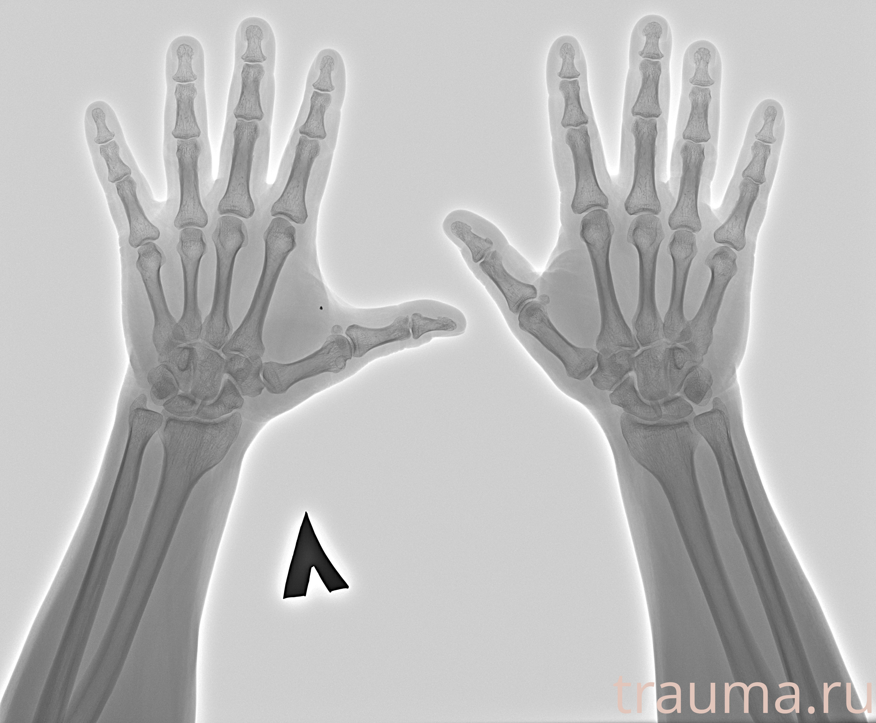 Рентген на дому: по вашему адресу приезжает врач-рентгенолог, травматолог-ортопед с мобильным рентгеновским аппаратом, проводит диагностику травмы или заболевания, делает необходимые рентгенограммы, дает рекомендации по дальнейшему лечению. Получить качественные снимки в домашних условиях возможно благодаря уникальной методике, разработанной МосРентген Центром для института  Склифосовского