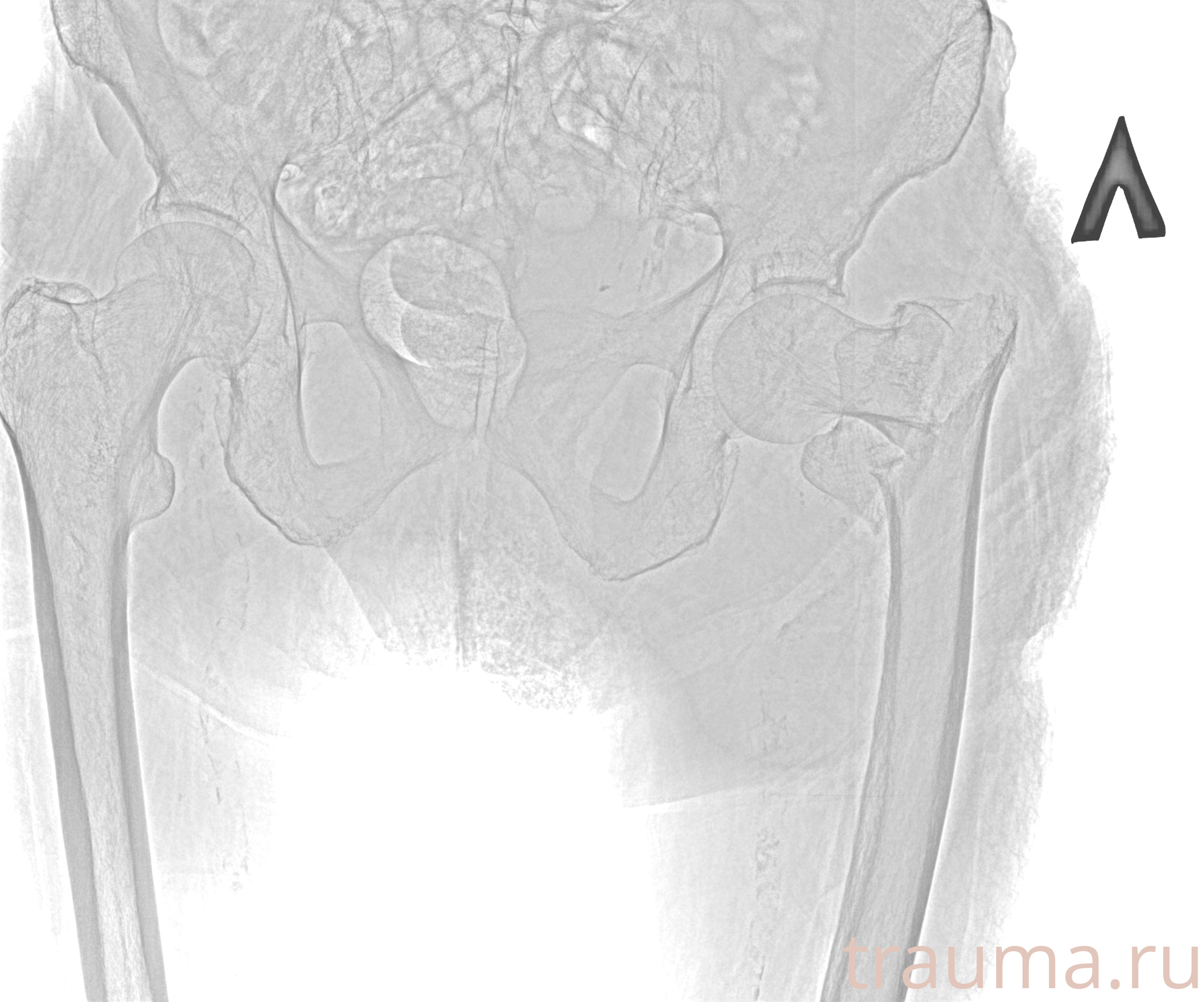 Рентген на дому: по вашему адресу приезжает врач-рентгенолог, травматолог-ортопед с мобильным рентгеновским аппаратом, проводит диагностику травмы или заболевания, делает необходимые рентгенограммы, дает рекомендации по дальнейшему лечению. Получить качественные снимки в домашних условиях возможно благодаря уникальной методике, разработанной МосРентген Центром для института  Склифосовского