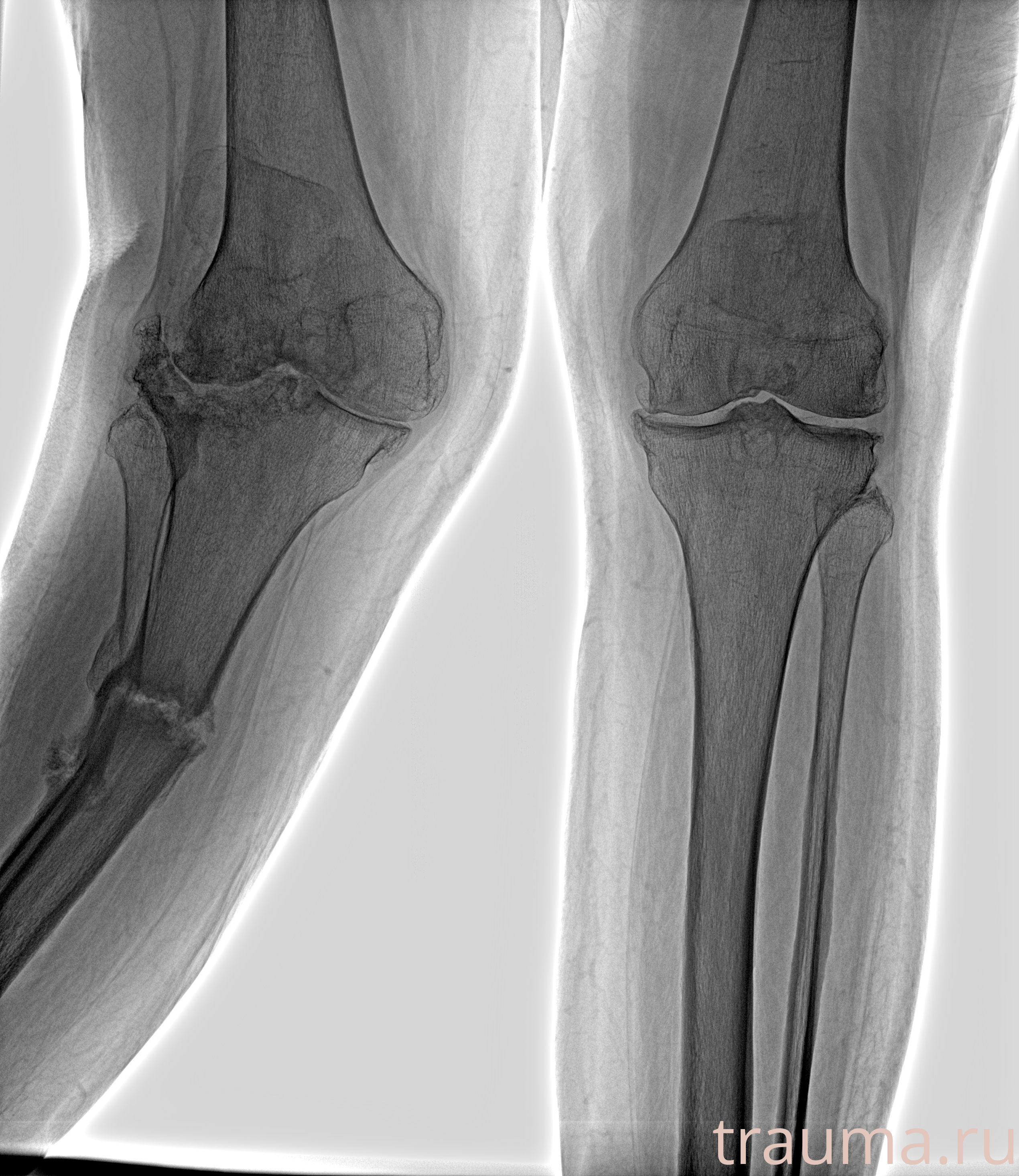 Рентген на дому: по вашему адресу приезжает врач-рентгенолог, травматолог-ортопед с мобильным рентгеновским аппаратом, проводит диагностику травмы или заболевания, делает необходимые рентгенограммы, дает рекомендации по дальнейшему лечению. Получить качественные снимки в домашних условиях возможно благодаря уникальной методике, разработанной МосРентген Центром для института  Склифосовского