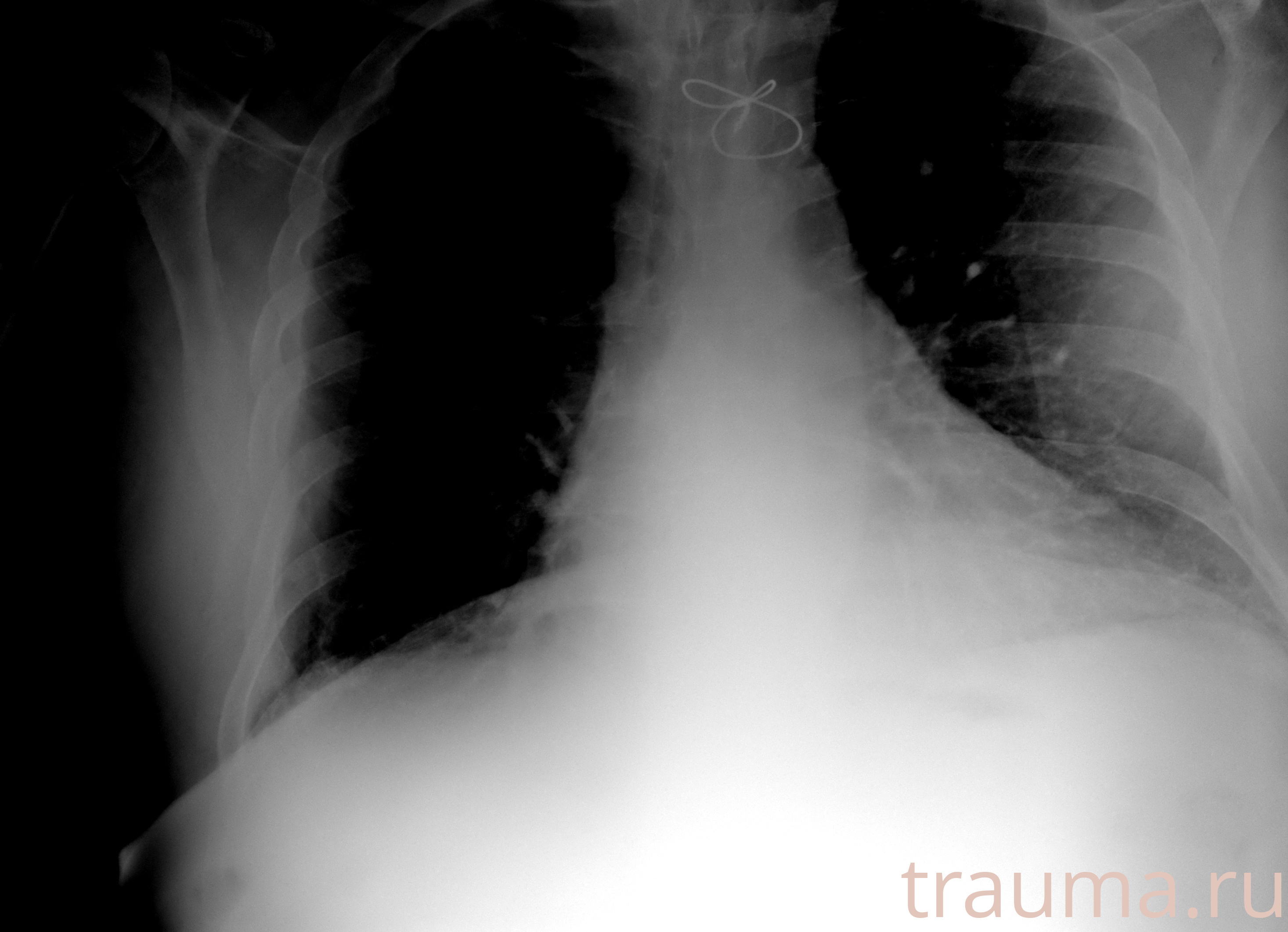 Рентген на дому: по вашему адресу приезжает врач-рентгенолог, травматолог-ортопед с мобильным рентгеновским аппаратом, проводит диагностику травмы или заболевания, делает необходимые рентгенограммы, дает рекомендации по дальнейшему лечению. Получить качественные снимки в домашних условиях возможно благодаря уникальной методике, разработанной МосРентген Центром для института  Склифосовского