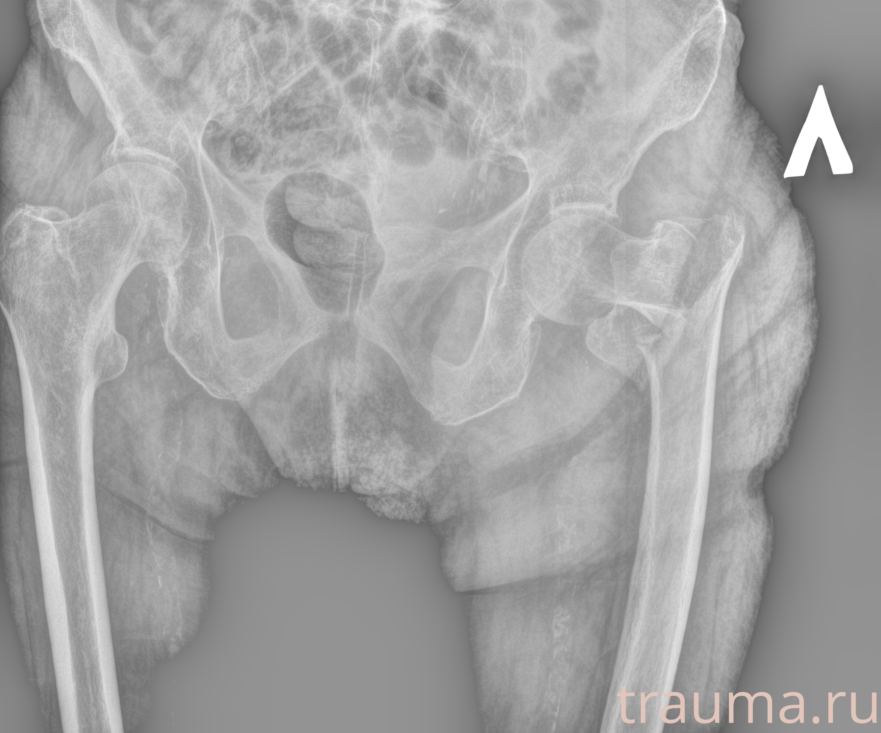 Рентген на дому: по вашему адресу приезжает врач-рентгенолог, травматолог-ортопед с мобильным рентгеновским аппаратом, проводит диагностику травмы или заболевания, делает необходимые рентгенограммы, дает рекомендации по дальнейшему лечению. Получить качественные снимки в домашних условиях возможно благодаря уникальной методике, разработанной МосРентген Центром для института  Склифосовского