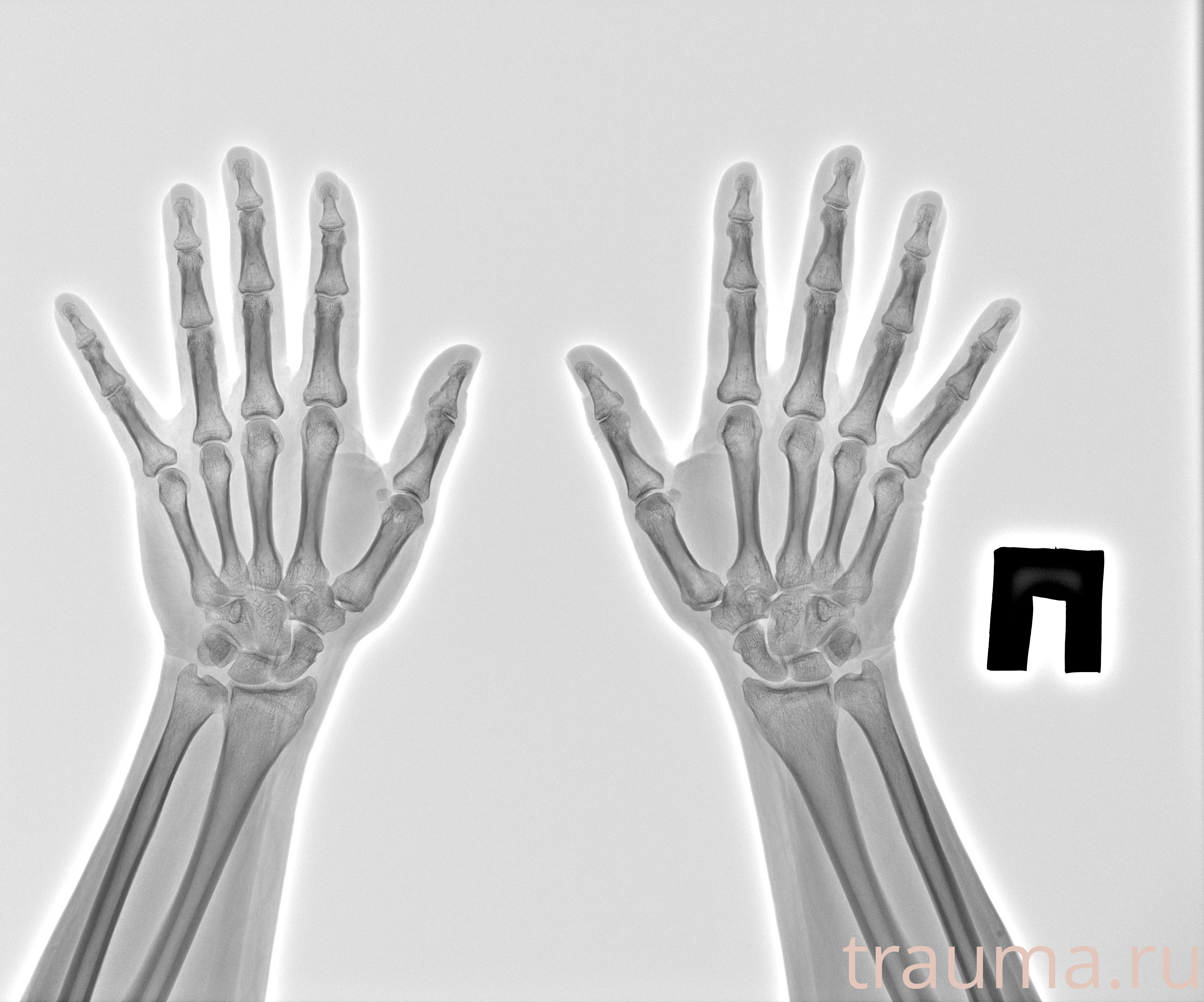 Рентген на дому: по вашему адресу приезжает врач-рентгенолог, травматолог-ортопед с мобильным рентгеновским аппаратом, проводит диагностику травмы или заболевания, делает необходимые рентгенограммы, дает рекомендации по дальнейшему лечению. Получить качественные снимки в домашних условиях возможно благодаря уникальной методике, разработанной МосРентген Центром для института  Склифосовского