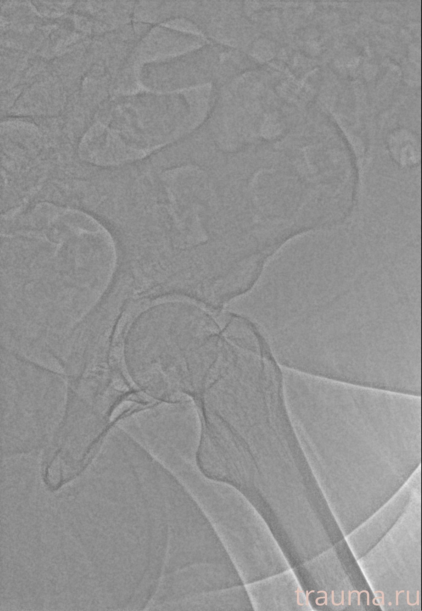 Рентген на дому: по вашему адресу приезжает врач-рентгенолог, травматолог-ортопед с мобильным рентгеновским аппаратом, проводит диагностику травмы или заболевания, делает необходимые рентгенограммы, дает рекомендации по дальнейшему лечению. Получить качественные снимки в домашних условиях возможно благодаря уникальной методике, разработанной МосРентген Центром для института  Склифосовского