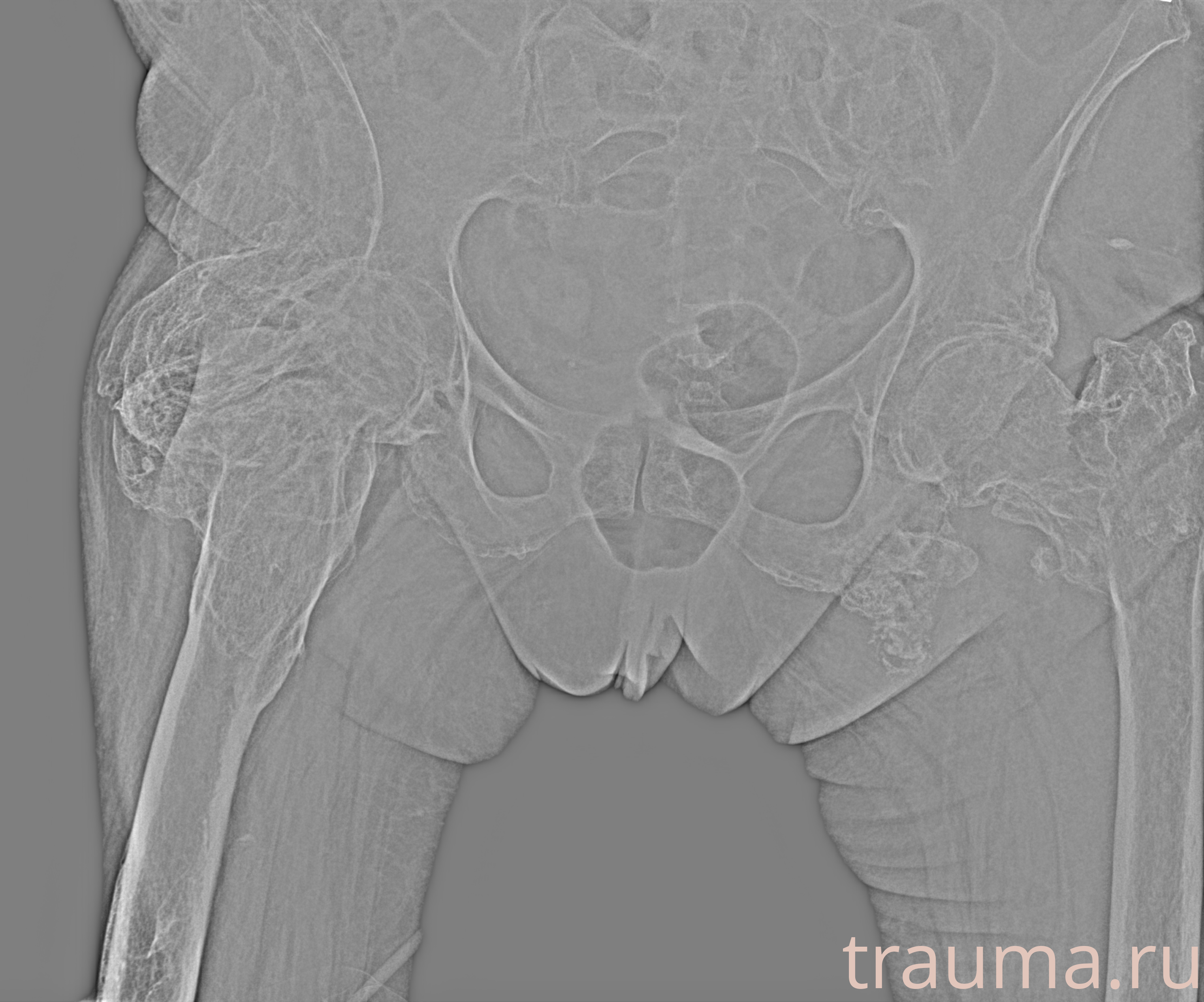 Рентген на дому: по вашему адресу приезжает врач-рентгенолог, травматолог-ортопед с мобильным рентгеновским аппаратом, проводит диагностику травмы или заболевания, делает необходимые рентгенограммы, дает рекомендации по дальнейшему лечению. Получить качественные снимки в домашних условиях возможно благодаря уникальной методике, разработанной МосРентген Центром для института  Склифосовского