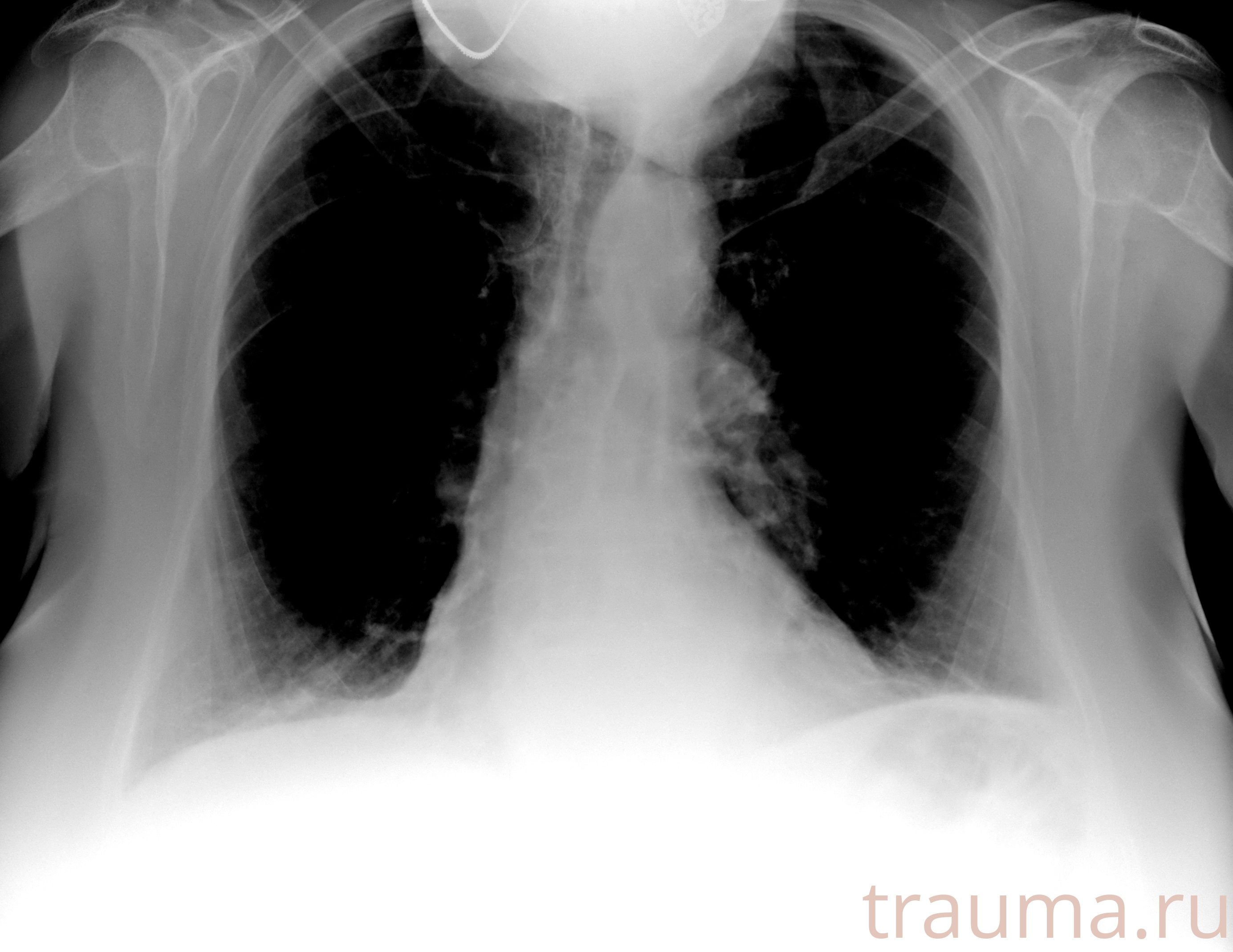 Рентген на дому: по вашему адресу приезжает врач-рентгенолог, травматолог-ортопед с мобильным рентгеновским аппаратом, проводит диагностику травмы или заболевания, делает необходимые рентгенограммы, дает рекомендации по дальнейшему лечению. Получить качественные снимки в домашних условиях возможно благодаря уникальной методике, разработанной МосРентген Центром для института  Склифосовского