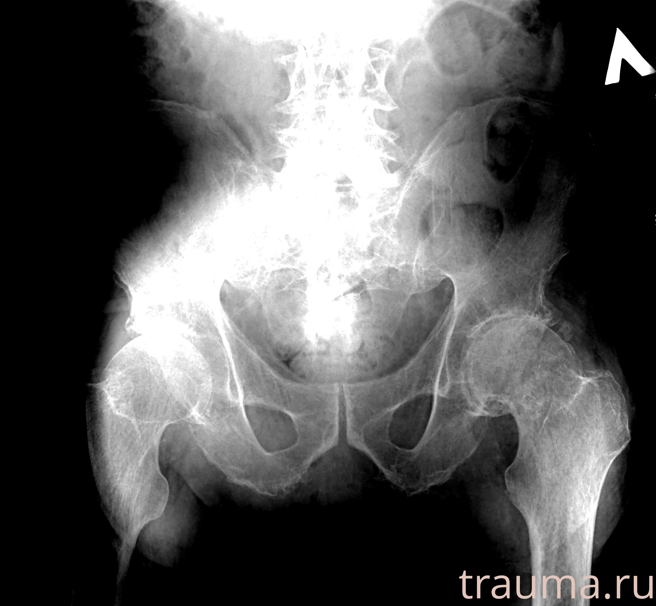 Рентген на дому: по вашему адресу приезжает врач-рентгенолог, травматолог-ортопед с мобильным рентгеновским аппаратом, проводит диагностику травмы или заболевания, делает необходимые рентгенограммы, дает рекомендации по дальнейшему лечению. Получить качественные снимки в домашних условиях возможно благодаря уникальной методике, разработанной МосРентген Центром для института  Склифосовского