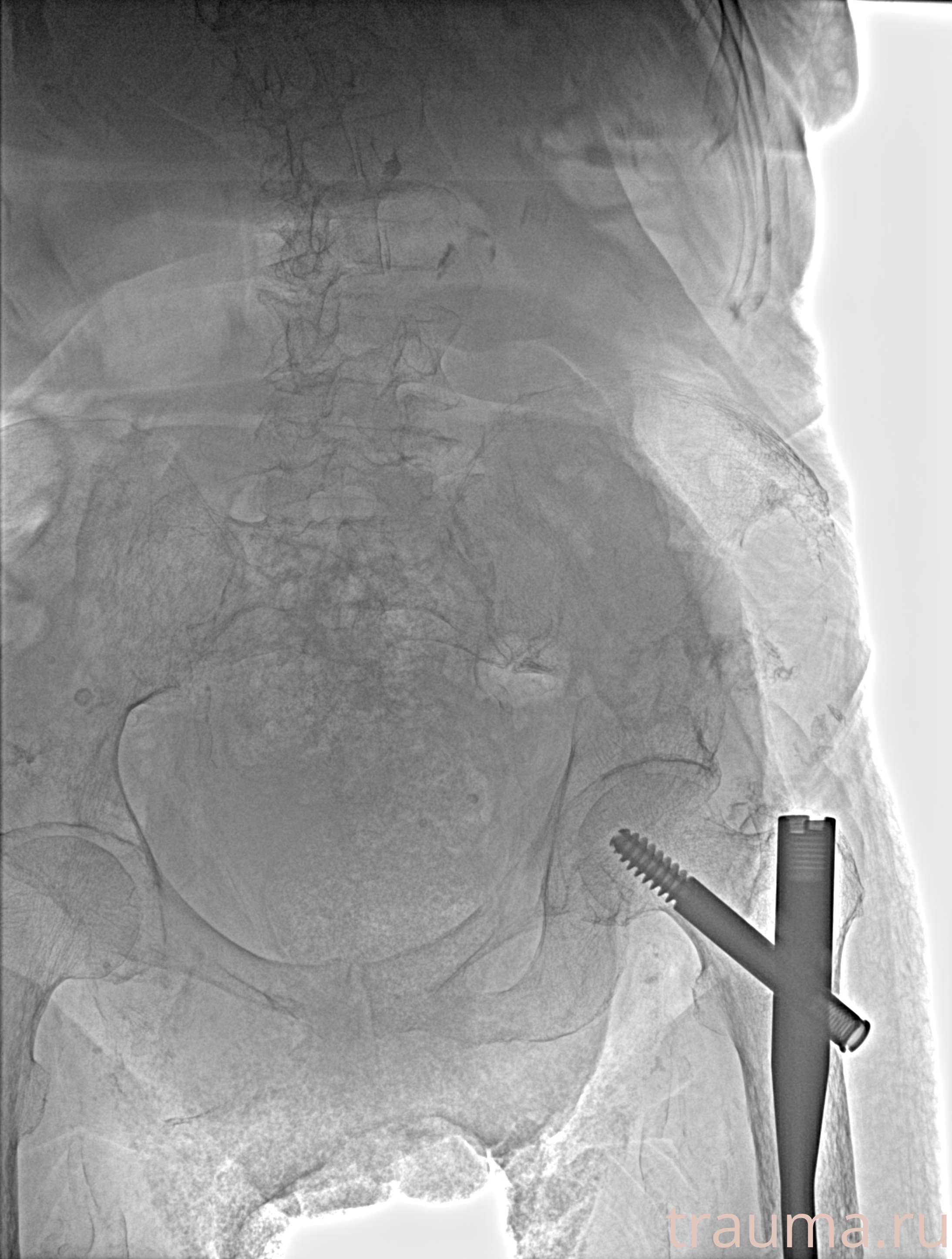 Рентген на дому: по вашему адресу приезжает врач-рентгенолог, травматолог-ортопед с мобильным рентгеновским аппаратом, проводит диагностику травмы или заболевания, делает необходимые рентгенограммы, дает рекомендации по дальнейшему лечению. Получить качественные снимки в домашних условиях возможно благодаря уникальной методике, разработанной МосРентген Центром для института  Склифосовского