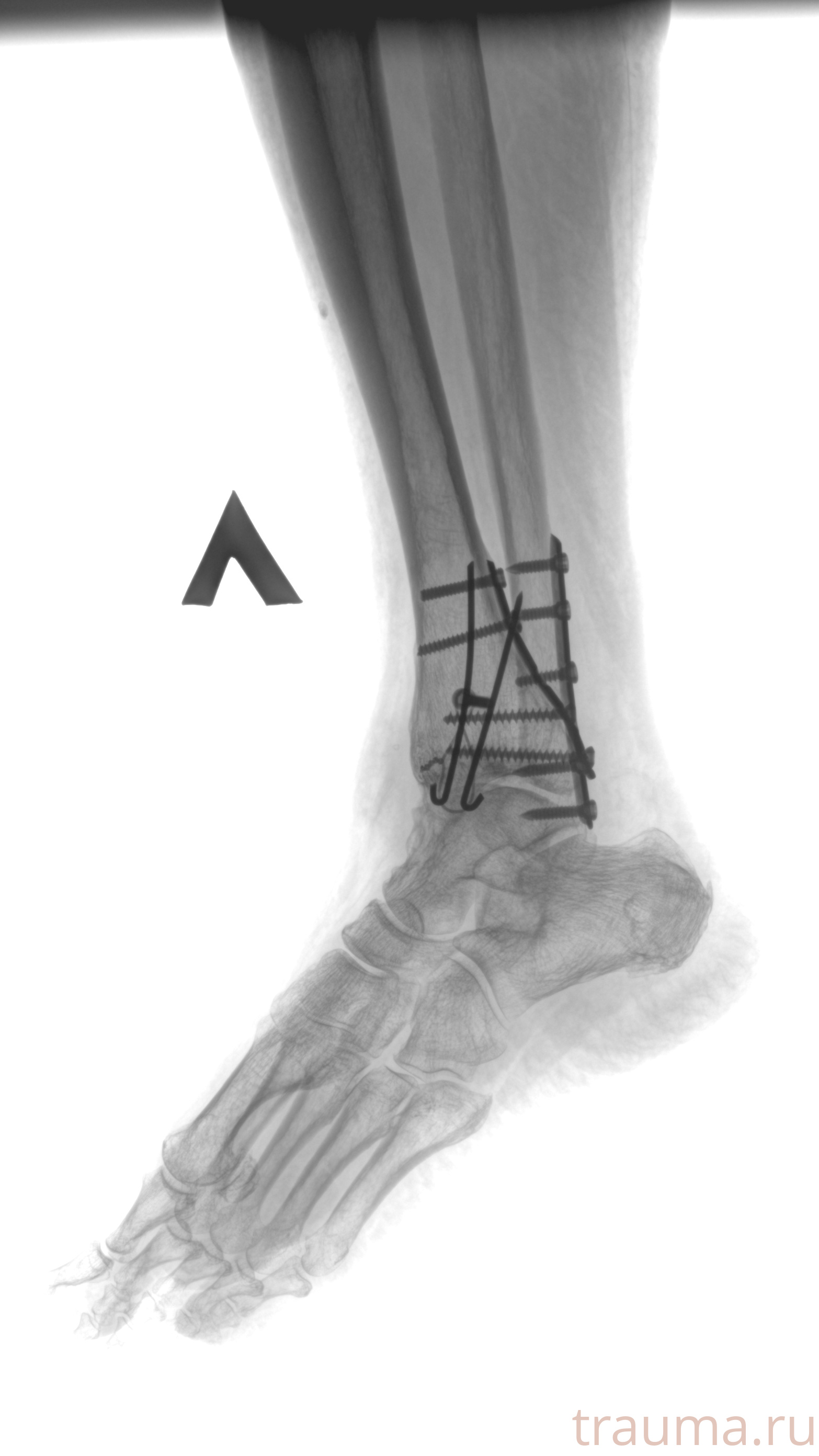 Рентген на дому: по вашему адресу приезжает врач-рентгенолог, травматолог-ортопед с мобильным рентгеновским аппаратом, проводит диагностику травмы или заболевания, делает необходимые рентгенограммы, дает рекомендации по дальнейшему лечению. Получить качественные снимки в домашних условиях возможно благодаря уникальной методике, разработанной МосРентген Центром для института  Склифосовского