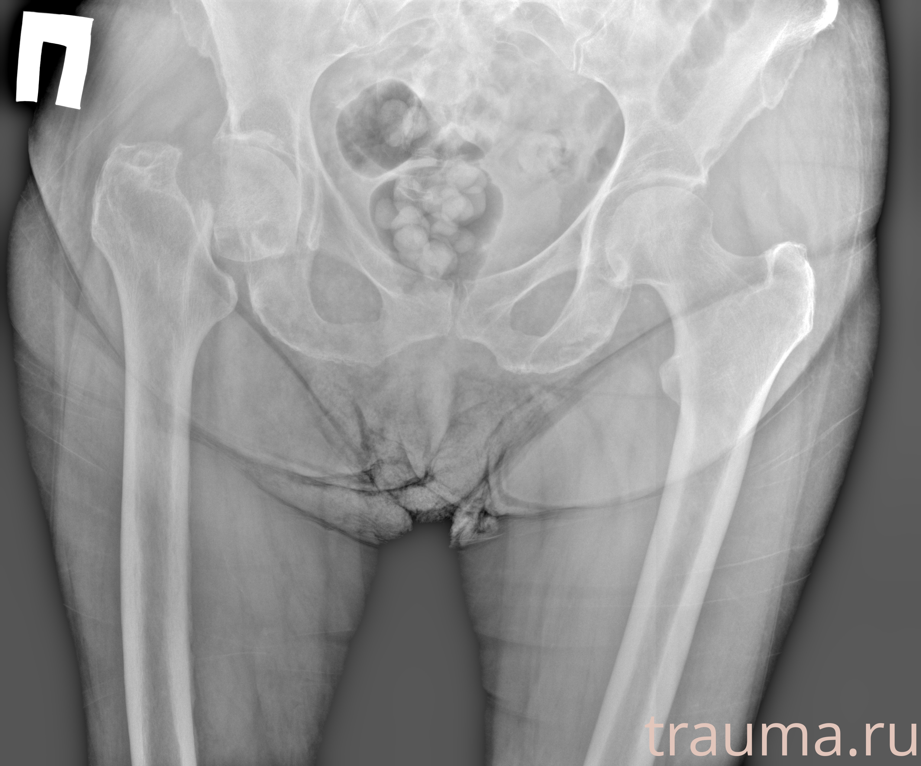 Рентген на дому: по вашему адресу приезжает врач-рентгенолог, травматолог-ортопед с мобильным рентгеновским аппаратом, проводит диагностику травмы или заболевания, делает необходимые рентгенограммы, дает рекомендации по дальнейшему лечению. Получить качественные снимки в домашних условиях возможно благодаря уникальной методике, разработанной МосРентген Центром для института  Склифосовского