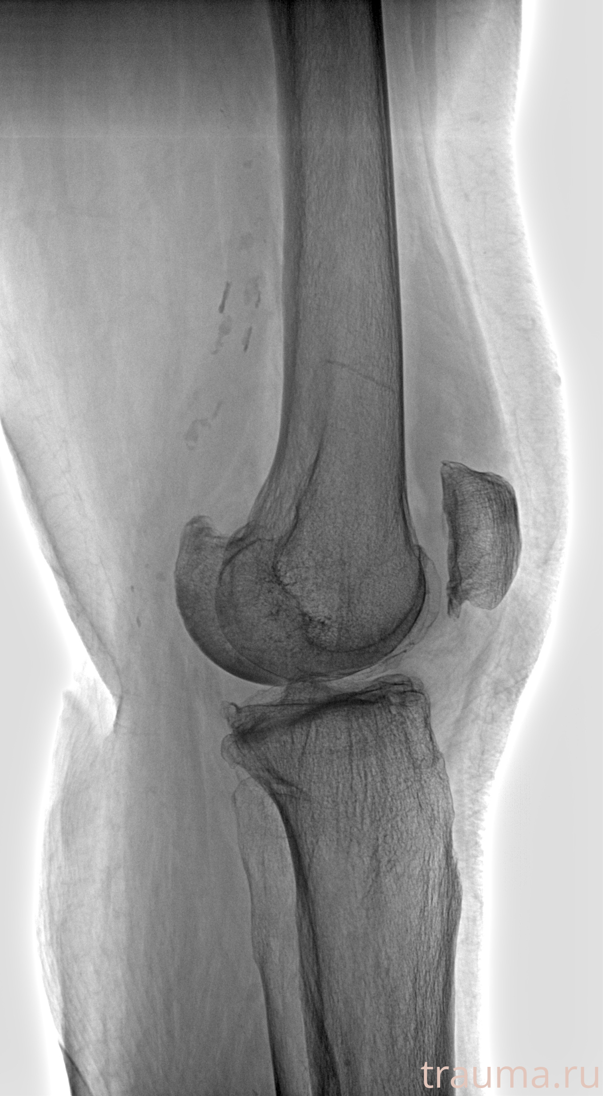 Рентген на дому: по вашему адресу приезжает врач-рентгенолог, травматолог-ортопед с мобильным рентгеновским аппаратом, проводит диагностику травмы или заболевания, делает необходимые рентгенограммы, дает рекомендации по дальнейшему лечению. Получить качественные снимки в домашних условиях возможно благодаря уникальной методике, разработанной МосРентген Центром для института  Склифосовского