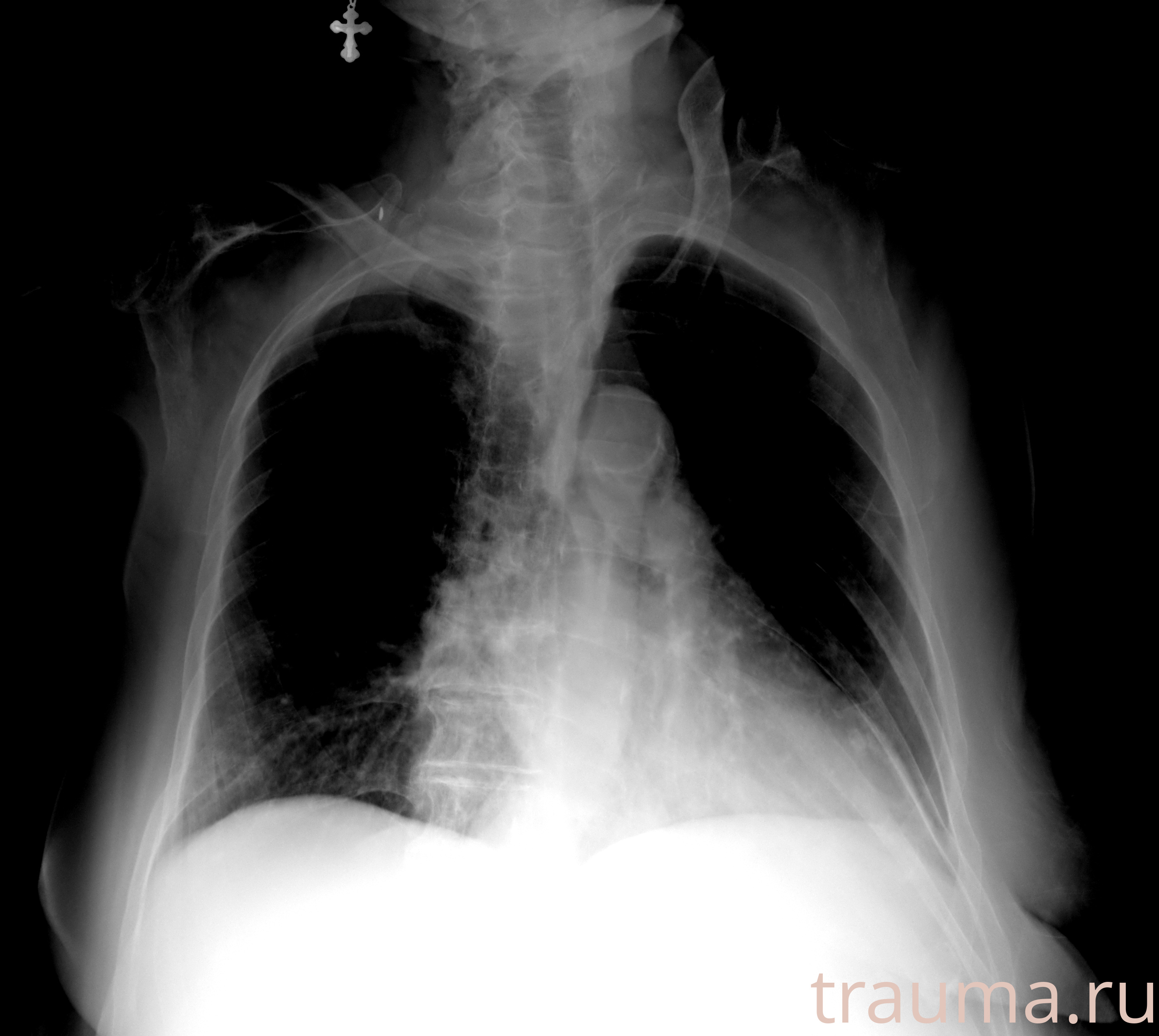 Рентген на дому: по вашему адресу приезжает врач-рентгенолог, травматолог-ортопед с мобильным рентгеновским аппаратом, проводит диагностику травмы или заболевания, делает необходимые рентгенограммы, дает рекомендации по дальнейшему лечению. Получить качественные снимки в домашних условиях возможно благодаря уникальной методике, разработанной МосРентген Центром для института  Склифосовского