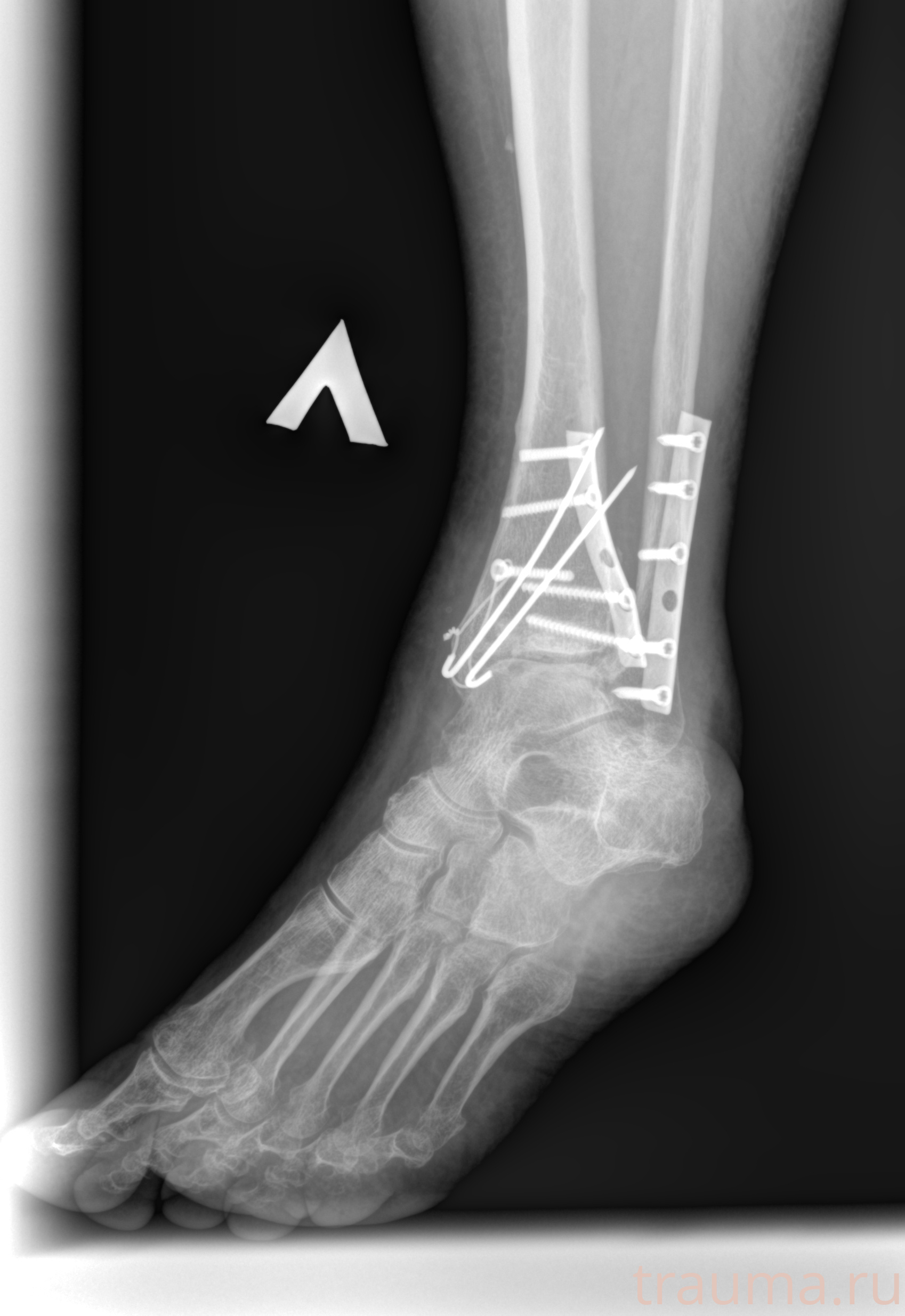 Рентген на дому: по вашему адресу приезжает врач-рентгенолог, травматолог-ортопед с мобильным рентгеновским аппаратом, проводит диагностику травмы или заболевания, делает необходимые рентгенограммы, дает рекомендации по дальнейшему лечению. Получить качественные снимки в домашних условиях возможно благодаря уникальной методике, разработанной МосРентген Центром для института  Склифосовского