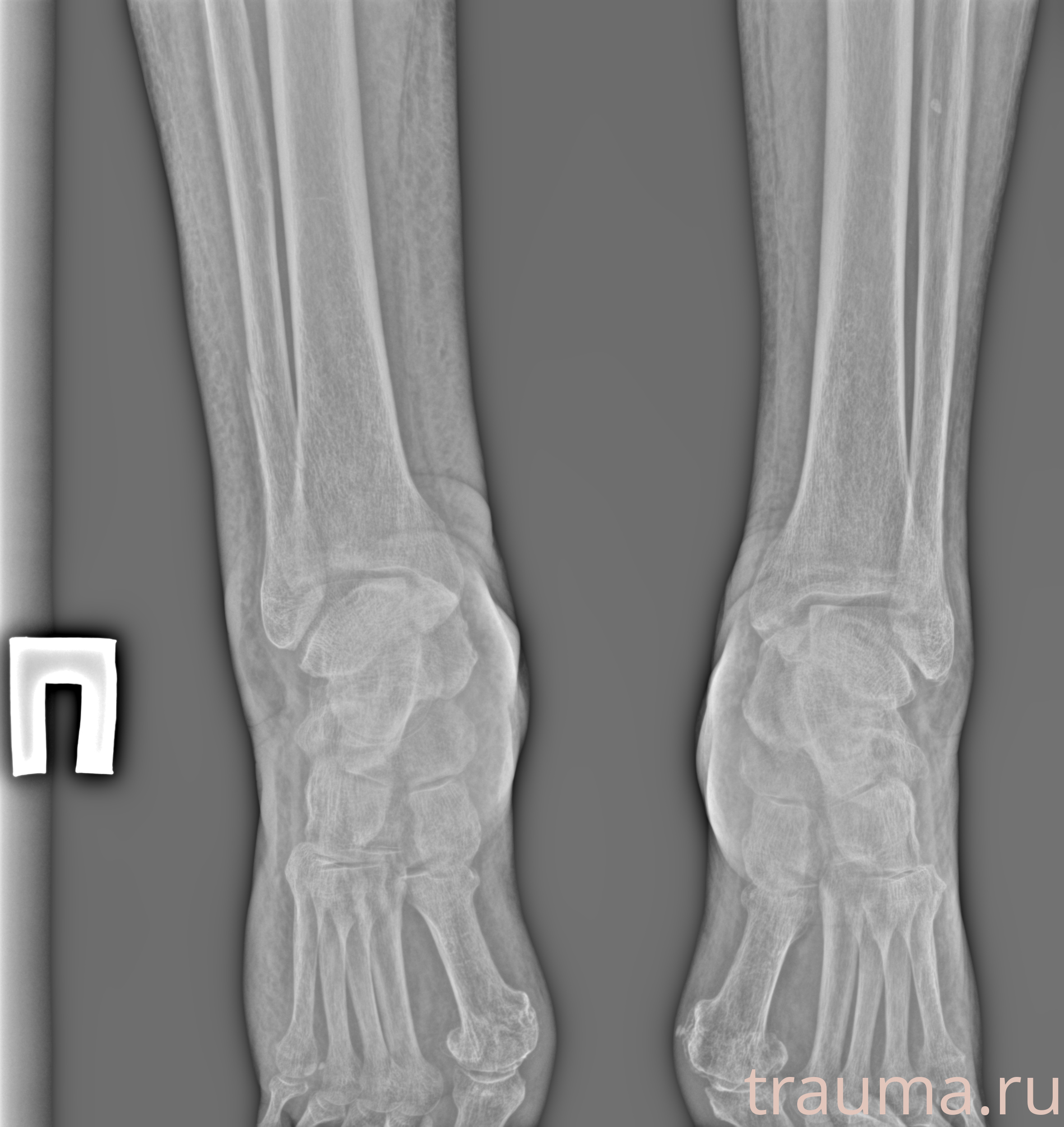 Рентген на дому: по вашему адресу приезжает врач-рентгенолог, травматолог-ортопед с мобильным рентгеновским аппаратом, проводит диагностику травмы или заболевания, делает необходимые рентгенограммы, дает рекомендации по дальнейшему лечению. Получить качественные снимки в домашних условиях возможно благодаря уникальной методике, разработанной МосРентген Центром для института  Склифосовского