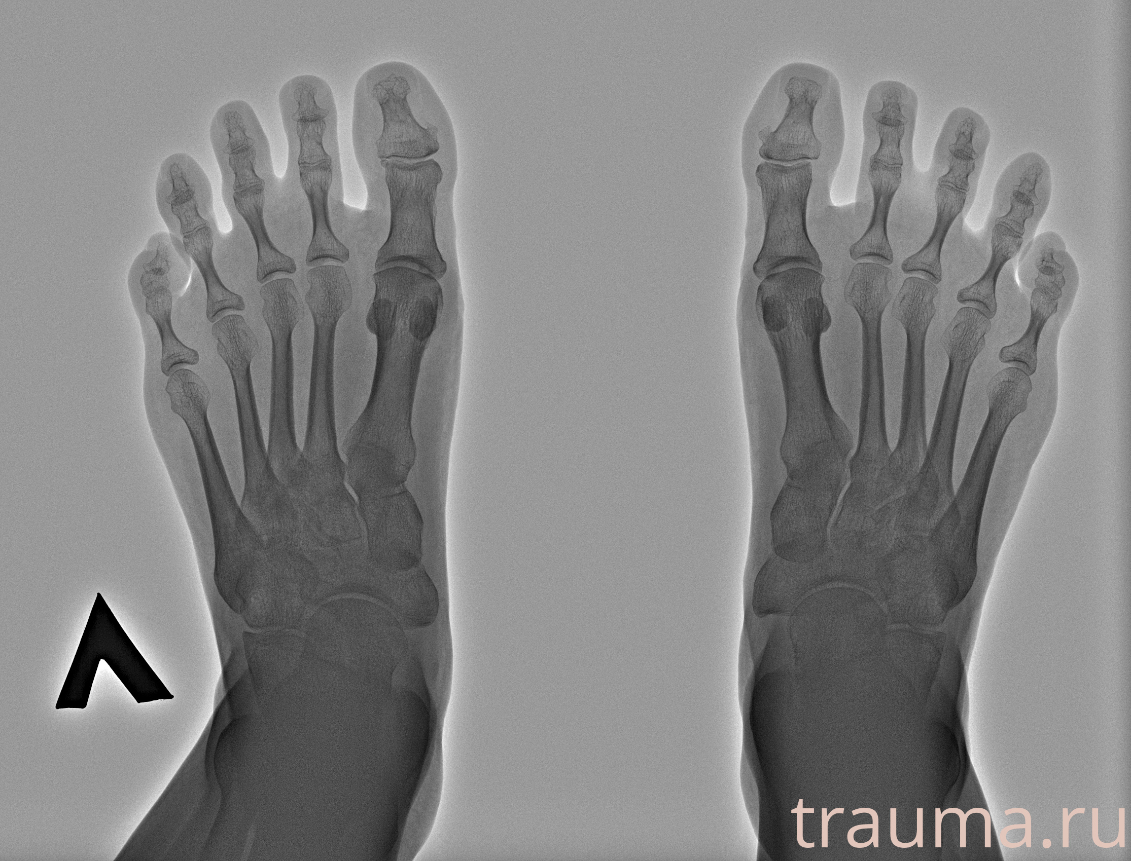 Рентген на дому: по вашему адресу приезжает врач-рентгенолог, травматолог-ортопед с мобильным рентгеновским аппаратом, проводит диагностику травмы или заболевания, делает необходимые рентгенограммы, дает рекомендации по дальнейшему лечению. Получить качественные снимки в домашних условиях возможно благодаря уникальной методике, разработанной МосРентген Центром для института  Склифосовского