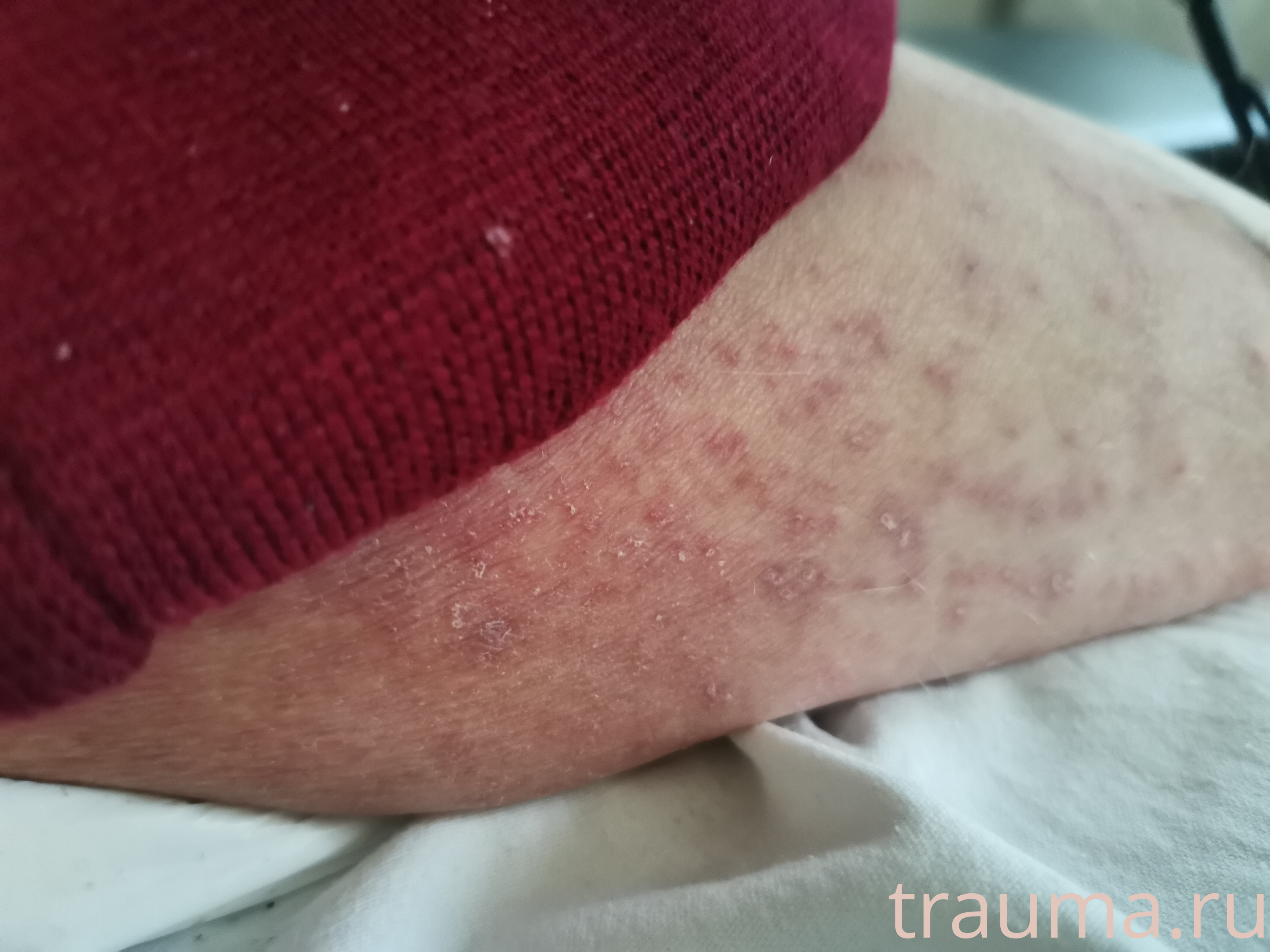 Рентген на дому: по вашему адресу приезжает врач-рентгенолог, травматолог-ортопед с мобильным рентгеновским аппаратом, проводит диагностику травмы или заболевания, делает необходимые рентгенограммы, дает рекомендации по дальнейшему лечению. Получить качественные снимки в домашних условиях возможно благодаря уникальной методике, разработанной МосРентген Центром для института  Склифосовского