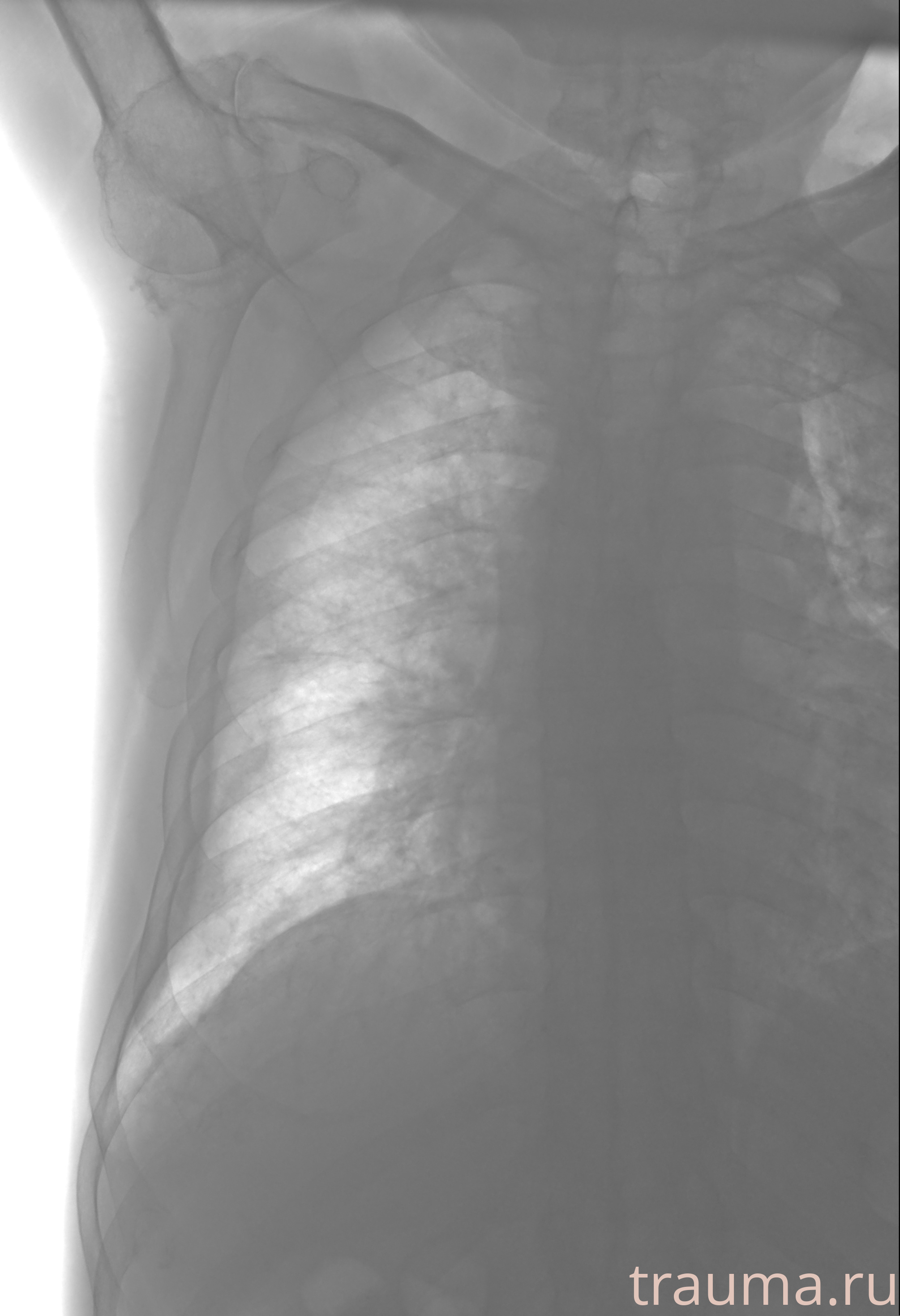 Рентген на дому: по вашему адресу приезжает врач-рентгенолог, травматолог-ортопед с мобильным рентгеновским аппаратом, проводит диагностику травмы или заболевания, делает необходимые рентгенограммы, дает рекомендации по дальнейшему лечению. Получить качественные снимки в домашних условиях возможно благодаря уникальной методике, разработанной МосРентген Центром для института  Склифосовского