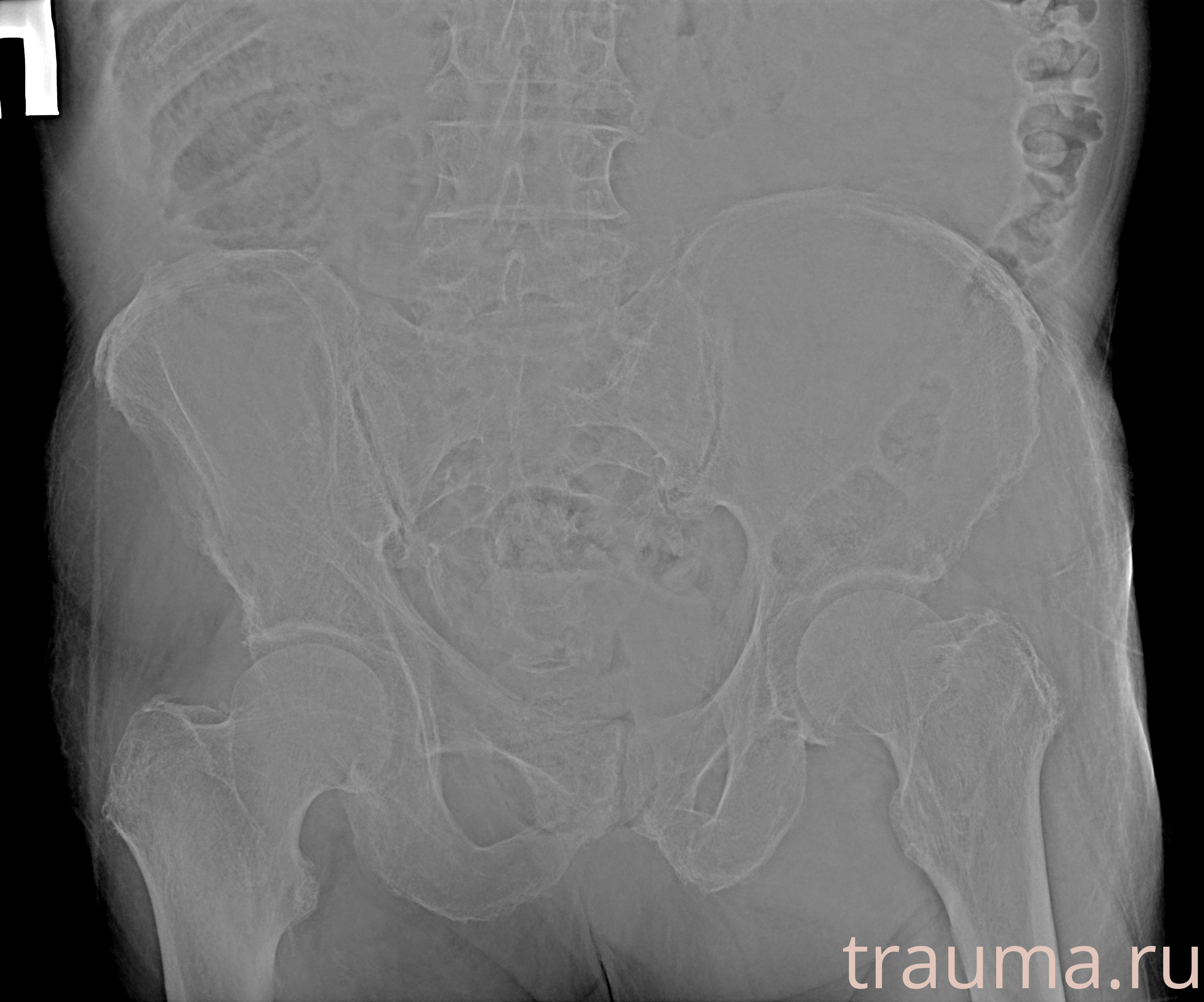 Рентген на дому: по вашему адресу приезжает врач-рентгенолог, травматолог-ортопед с мобильным рентгеновским аппаратом, проводит диагностику травмы или заболевания, делает необходимые рентгенограммы, дает рекомендации по дальнейшему лечению. Получить качественные снимки в домашних условиях возможно благодаря уникальной методике, разработанной МосРентген Центром для института  Склифосовского