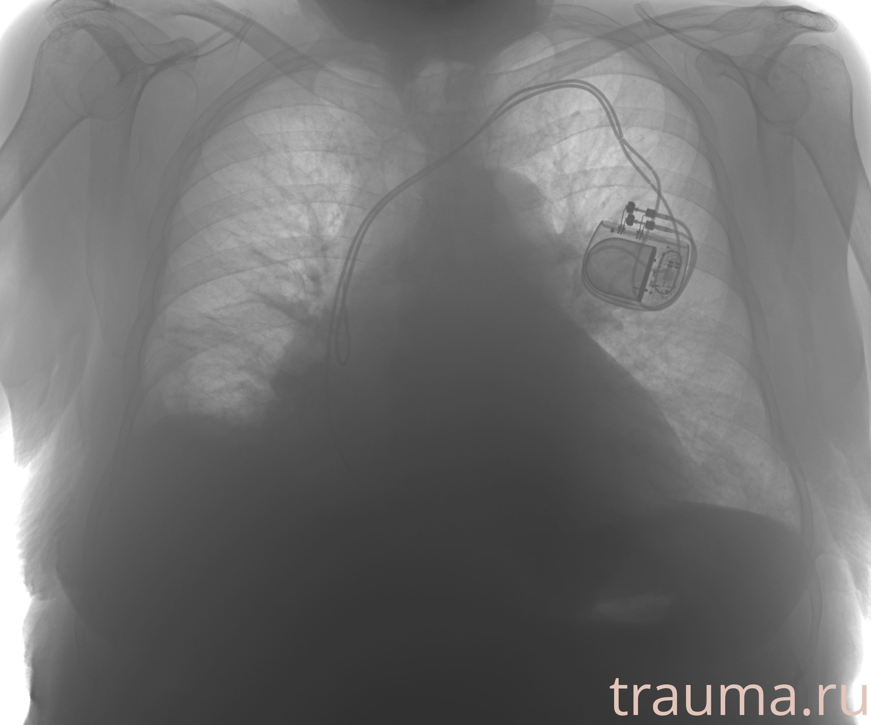 Рентген на дому: по вашему адресу приезжает врач-рентгенолог, травматолог-ортопед с мобильным рентгеновским аппаратом, проводит диагностику травмы или заболевания, делает необходимые рентгенограммы, дает рекомендации по дальнейшему лечению. Получить качественные снимки в домашних условиях возможно благодаря уникальной методике, разработанной МосРентген Центром для института  Склифосовского