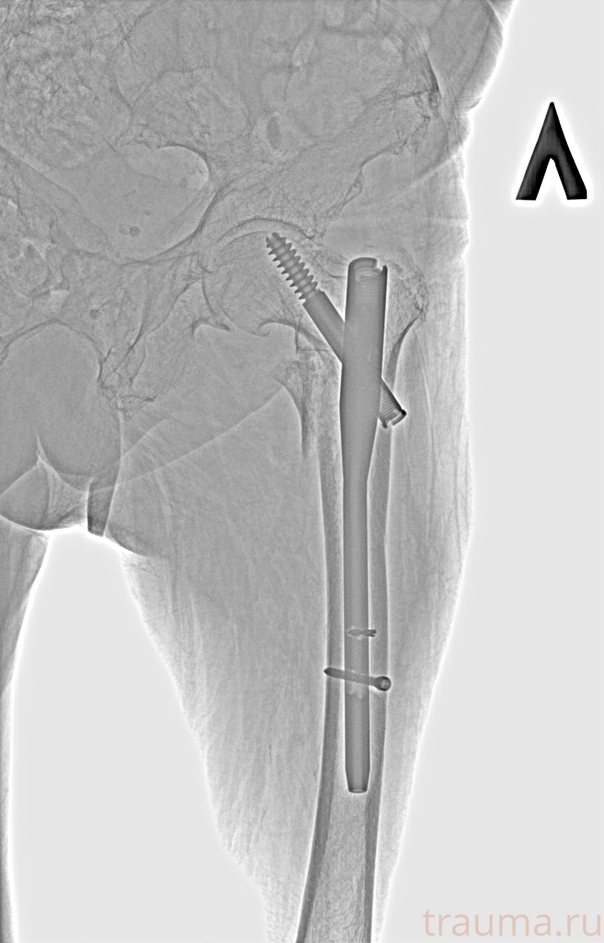 Рентген на дому: по вашему адресу приезжает врач-рентгенолог, травматолог-ортопед с мобильным рентгеновским аппаратом, проводит диагностику травмы или заболевания, делает необходимые рентгенограммы, дает рекомендации по дальнейшему лечению. Получить качественные снимки в домашних условиях возможно благодаря уникальной методике, разработанной МосРентген Центром для института  Склифосовского