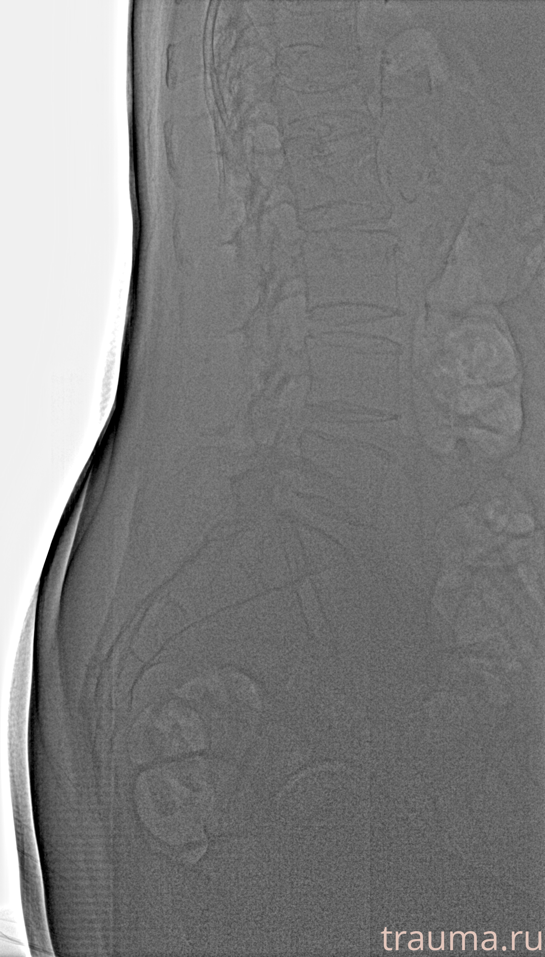 Рентген на дому: по вашему адресу приезжает врач-рентгенолог, травматолог-ортопед с мобильным рентгеновским аппаратом, проводит диагностику травмы или заболевания, делает необходимые рентгенограммы, дает рекомендации по дальнейшему лечению. Получить качественные снимки в домашних условиях возможно благодаря уникальной методике, разработанной МосРентген Центром для института  Склифосовского