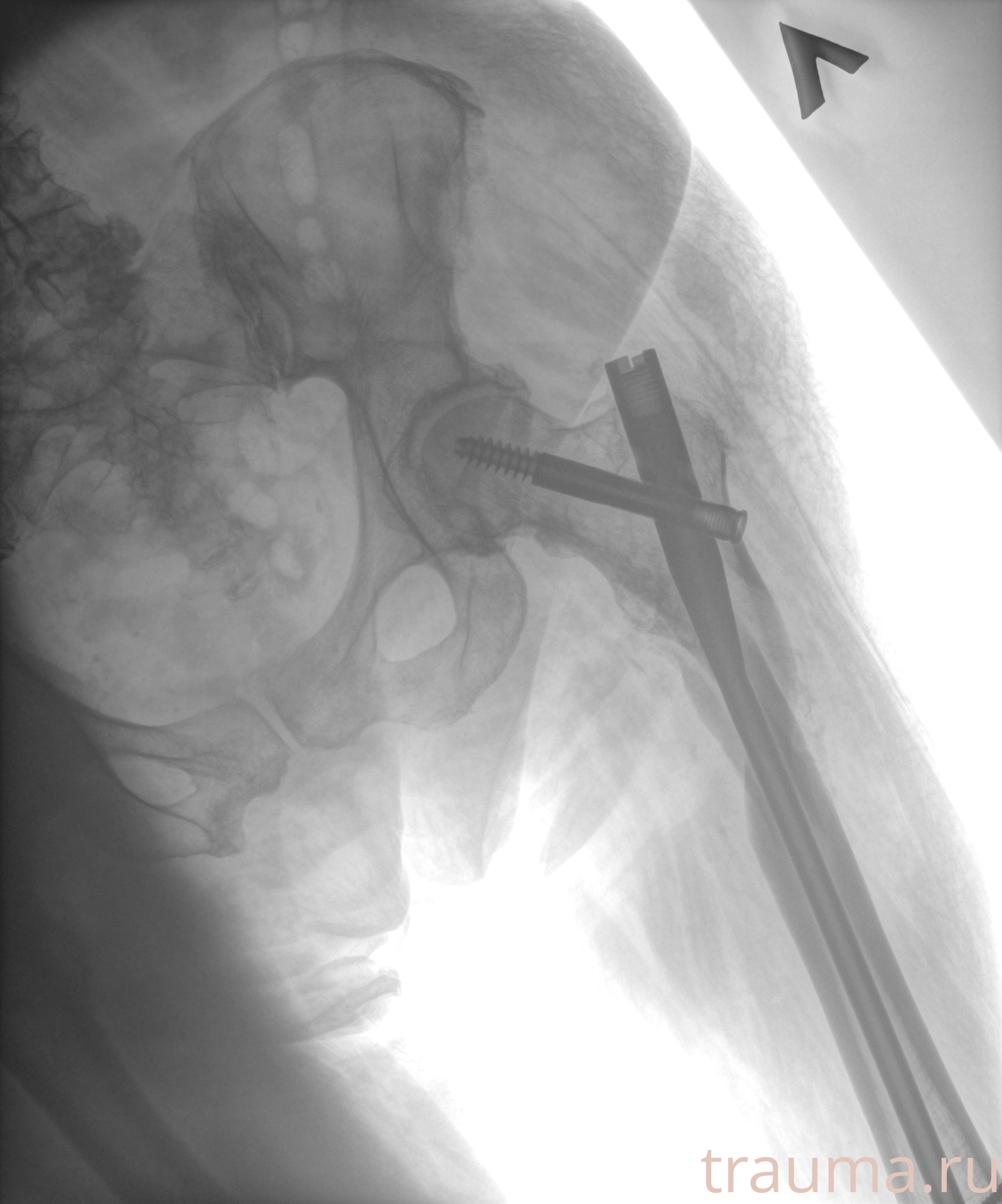 Рентген на дому: по вашему адресу приезжает врач-рентгенолог, травматолог-ортопед с мобильным рентгеновским аппаратом, проводит диагностику травмы или заболевания, делает необходимые рентгенограммы, дает рекомендации по дальнейшему лечению. Получить качественные снимки в домашних условиях возможно благодаря уникальной методике, разработанной МосРентген Центром для института  Склифосовского