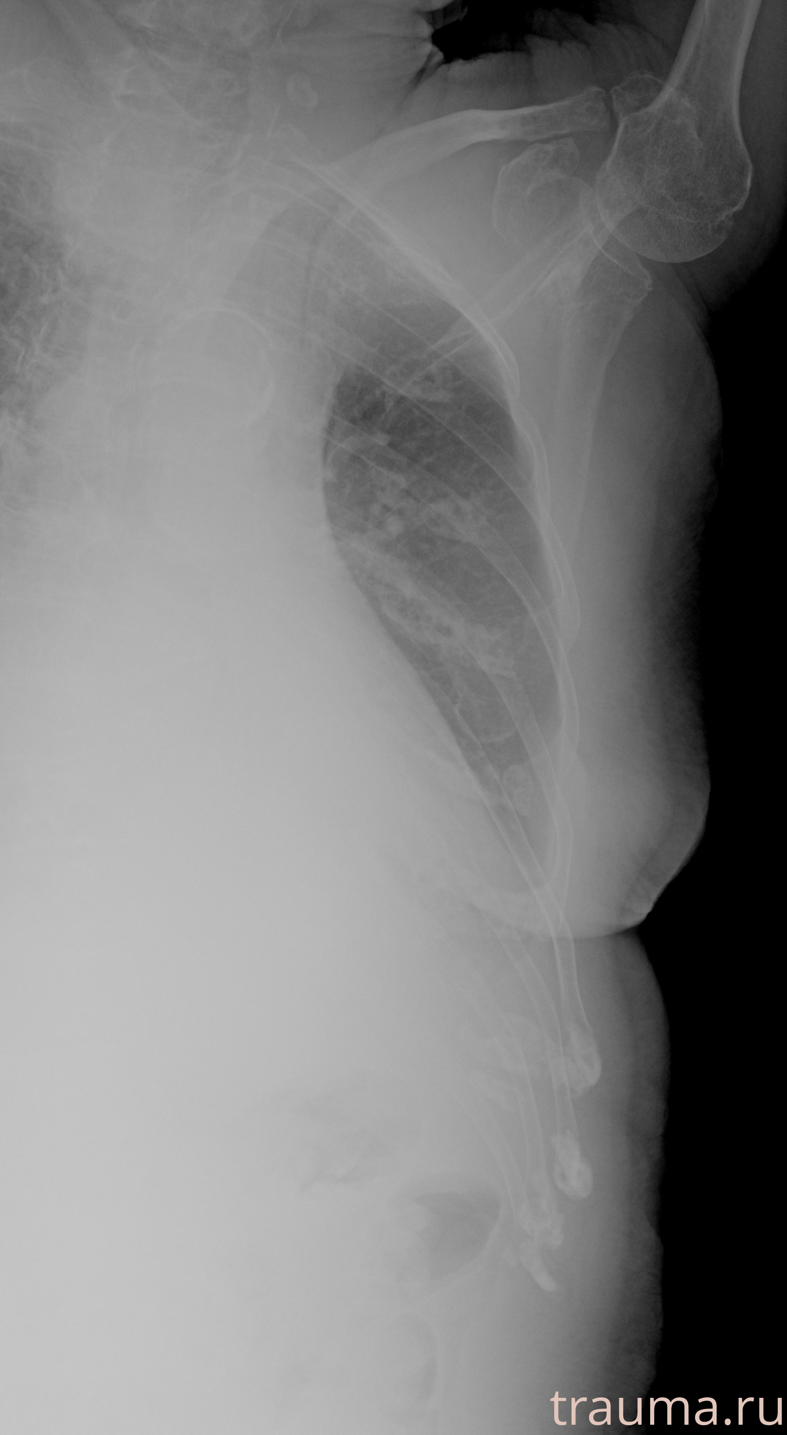 Рентген на дому: по вашему адресу приезжает врач-рентгенолог, травматолог-ортопед с мобильным рентгеновским аппаратом, проводит диагностику травмы или заболевания, делает необходимые рентгенограммы, дает рекомендации по дальнейшему лечению. Получить качественные снимки в домашних условиях возможно благодаря уникальной методике, разработанной МосРентген Центром для института  Склифосовского