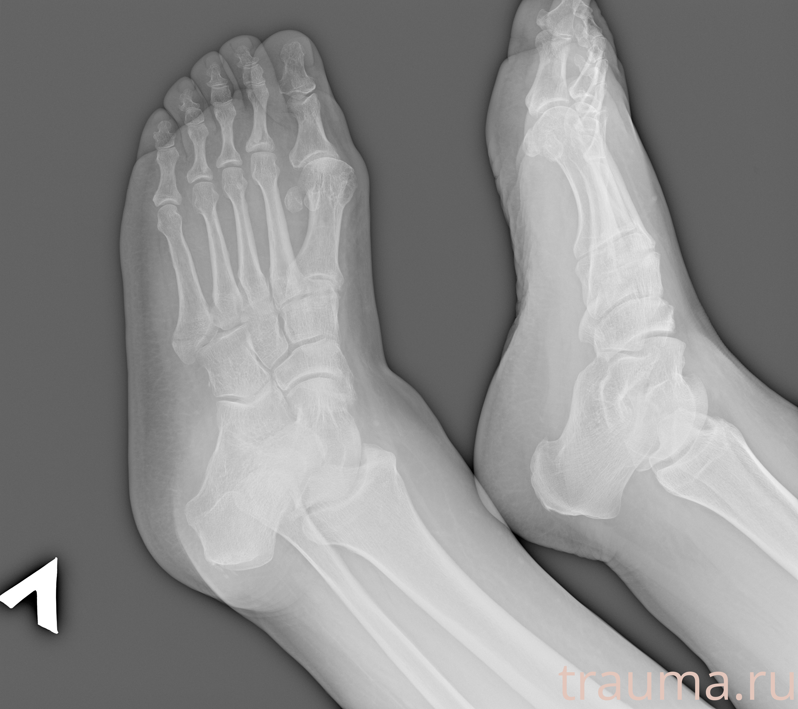 Рентген на дому: по вашему адресу приезжает врач-рентгенолог, травматолог-ортопед с мобильным рентгеновским аппаратом, проводит диагностику травмы или заболевания, делает необходимые рентгенограммы, дает рекомендации по дальнейшему лечению. Получить качественные снимки в домашних условиях возможно благодаря уникальной методике, разработанной МосРентген Центром для института  Склифосовского