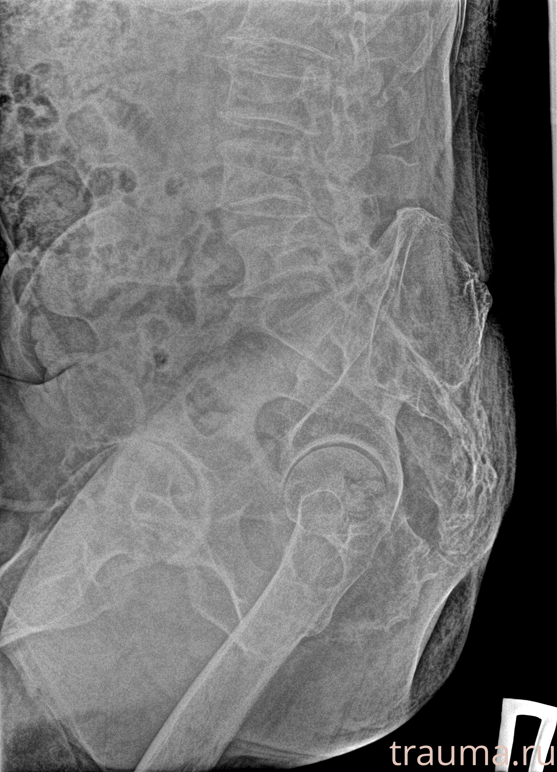 Рентген на дому: по вашему адресу приезжает врач-рентгенолог, травматолог-ортопед с мобильным рентгеновским аппаратом, проводит диагностику травмы или заболевания, делает необходимые рентгенограммы, дает рекомендации по дальнейшему лечению. Получить качественные снимки в домашних условиях возможно благодаря уникальной методике, разработанной МосРентген Центром для института  Склифосовского