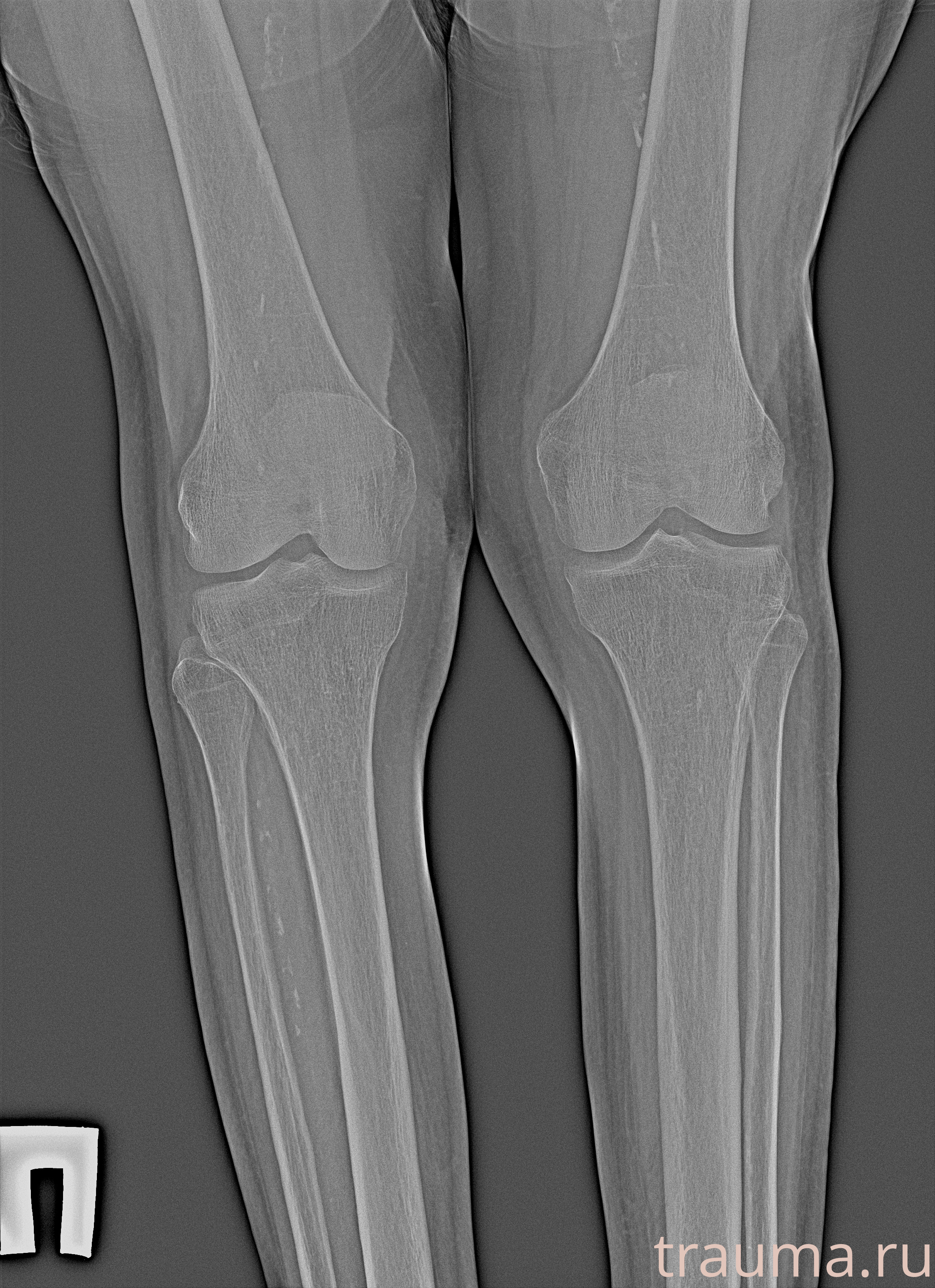Рентген на дому: по вашему адресу приезжает врач-рентгенолог, травматолог-ортопед с мобильным рентгеновским аппаратом, проводит диагностику травмы или заболевания, делает необходимые рентгенограммы, дает рекомендации по дальнейшему лечению. Получить качественные снимки в домашних условиях возможно благодаря уникальной методике, разработанной МосРентген Центром для института  Склифосовского