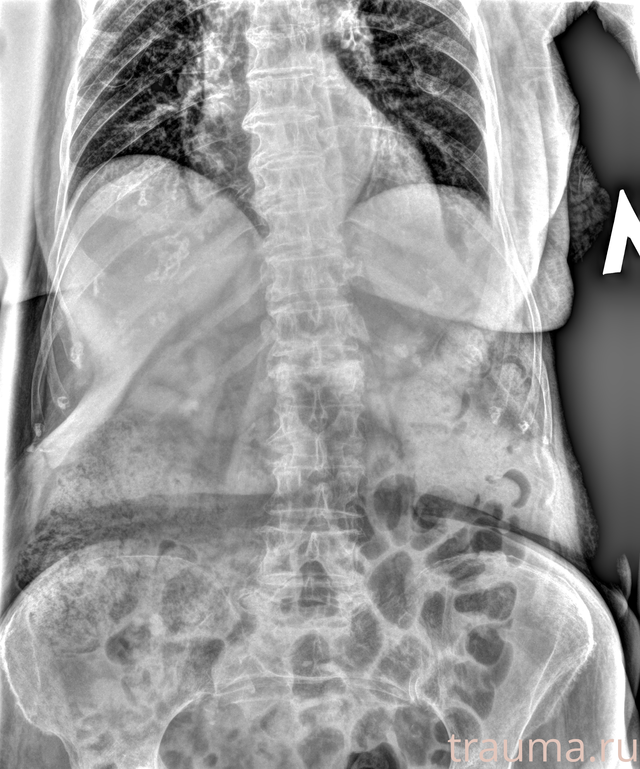 Рентген на дому: по вашему адресу приезжает врач-рентгенолог, травматолог-ортопед с мобильным рентгеновским аппаратом, проводит диагностику травмы или заболевания, делает необходимые рентгенограммы, дает рекомендации по дальнейшему лечению. Получить качественные снимки в домашних условиях возможно благодаря уникальной методике, разработанной МосРентген Центром для института  Склифосовского