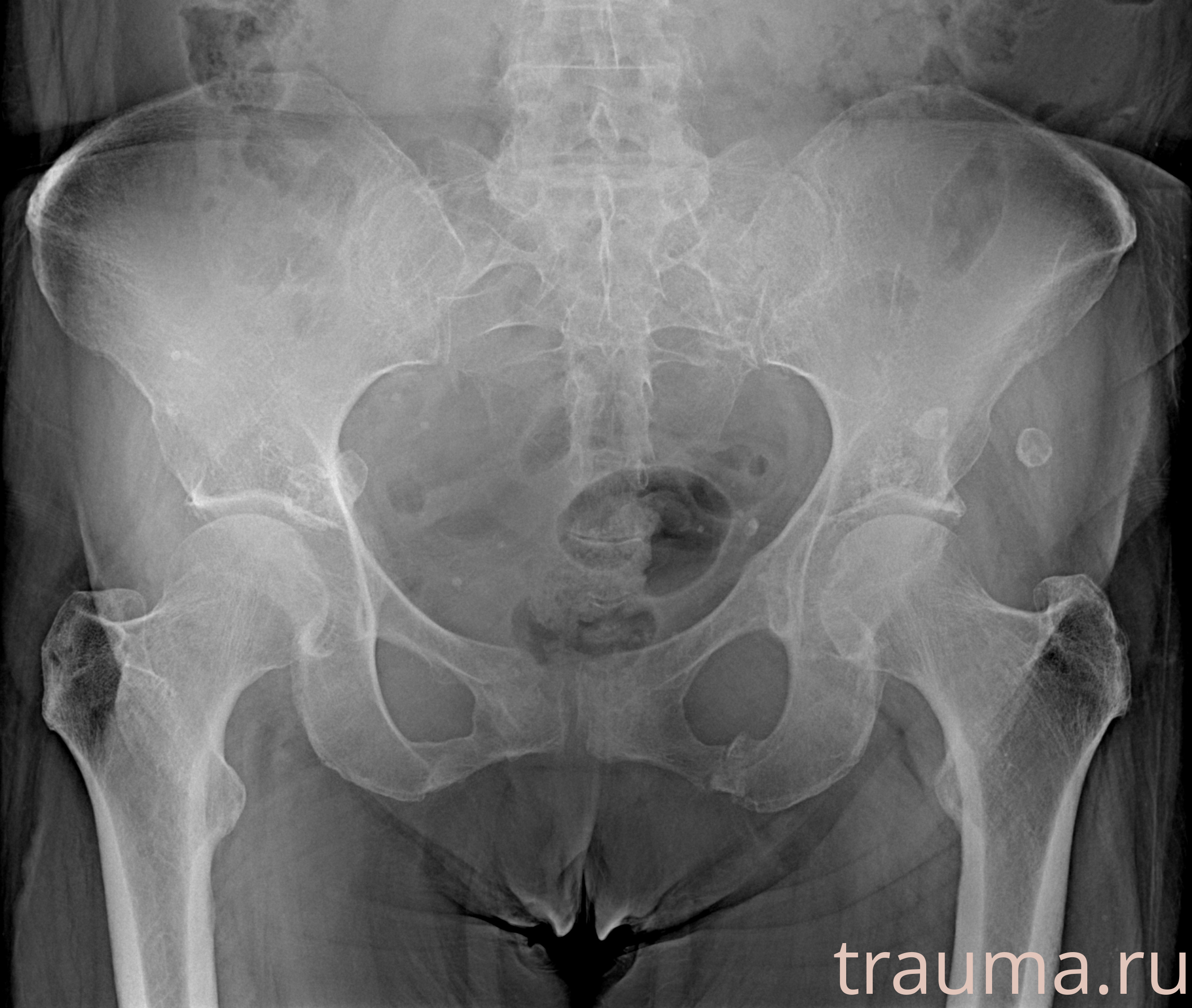 Рентген на дому: по вашему адресу приезжает врач-рентгенолог, травматолог-ортопед с мобильным рентгеновским аппаратом, проводит диагностику травмы или заболевания, делает необходимые рентгенограммы, дает рекомендации по дальнейшему лечению. Получить качественные снимки в домашних условиях возможно благодаря уникальной методике, разработанной МосРентген Центром для института  Склифосовского