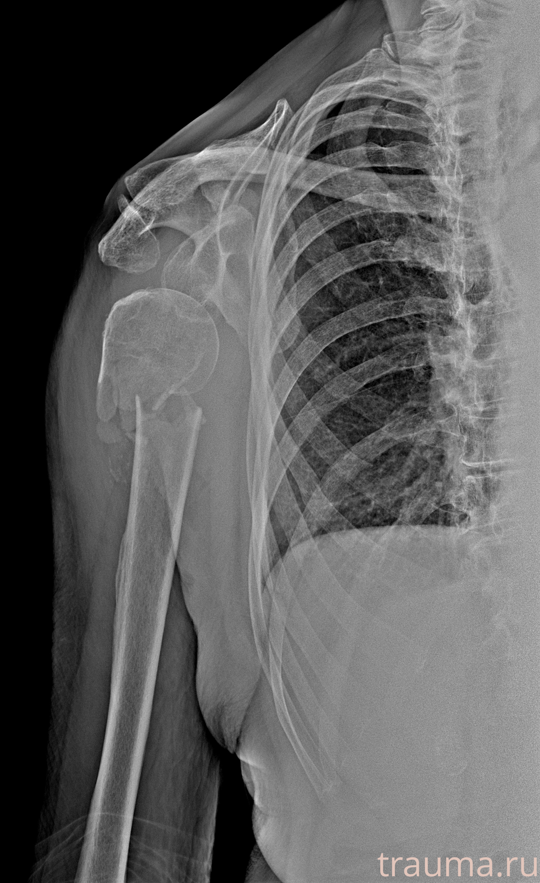 Рентген на дому: по вашему адресу приезжает врач-рентгенолог, травматолог-ортопед с мобильным рентгеновским аппаратом, проводит диагностику травмы или заболевания, делает необходимые рентгенограммы, дает рекомендации по дальнейшему лечению. Получить качественные снимки в домашних условиях возможно благодаря уникальной методике, разработанной МосРентген Центром для института  Склифосовского