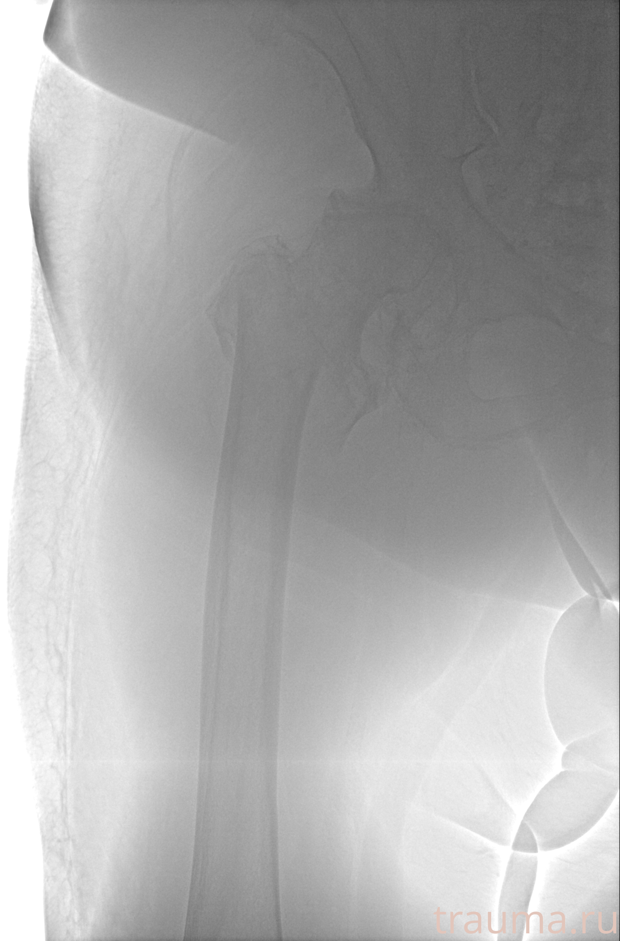 Рентген на дому: по вашему адресу приезжает врач-рентгенолог, травматолог-ортопед с мобильным рентгеновским аппаратом, проводит диагностику травмы или заболевания, делает необходимые рентгенограммы, дает рекомендации по дальнейшему лечению. Получить качественные снимки в домашних условиях возможно благодаря уникальной методике, разработанной МосРентген Центром для института  Склифосовского