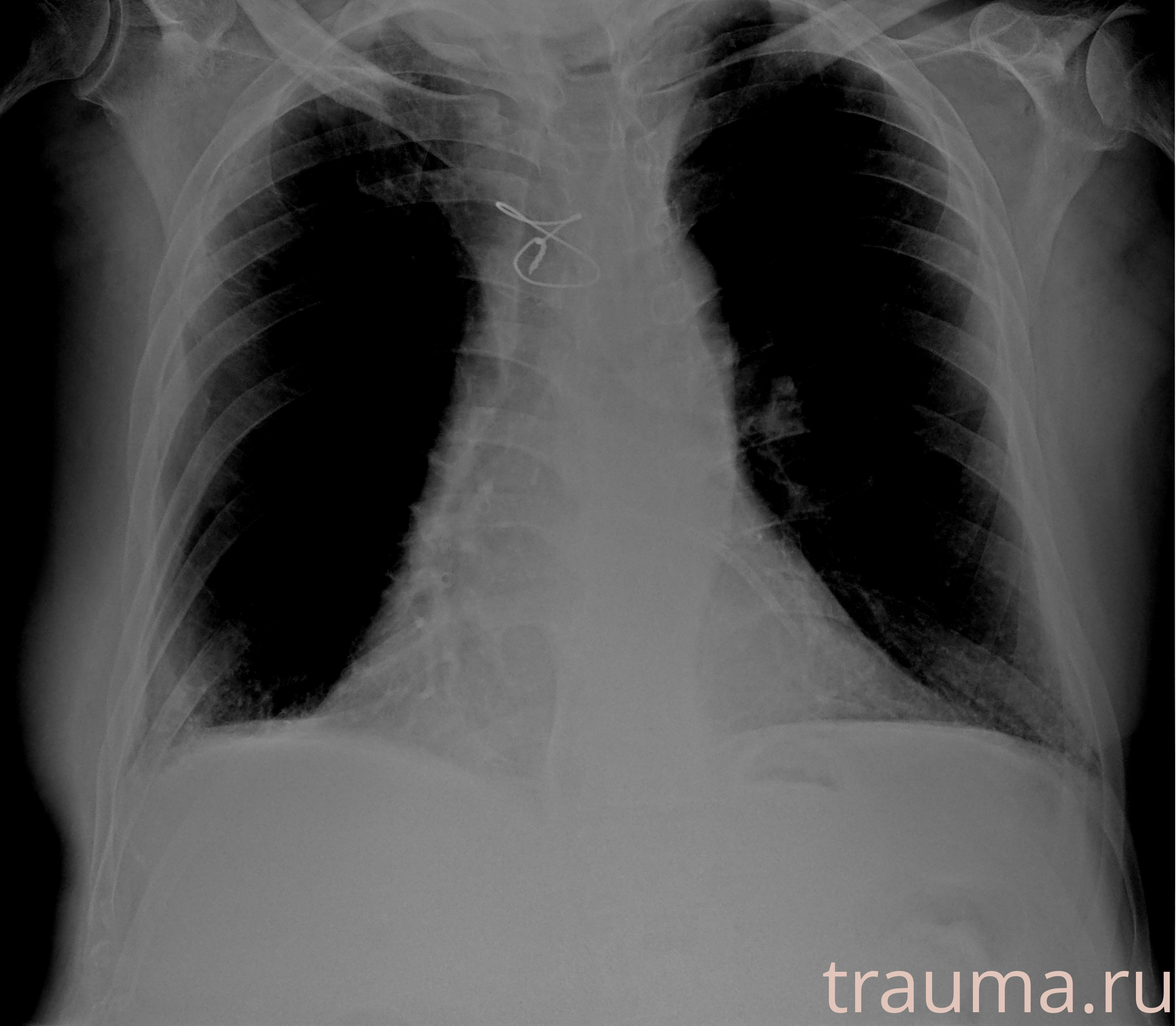 Рентген на дому: по вашему адресу приезжает врач-рентгенолог, травматолог-ортопед с мобильным рентгеновским аппаратом, проводит диагностику травмы или заболевания, делает необходимые рентгенограммы, дает рекомендации по дальнейшему лечению. Получить качественные снимки в домашних условиях возможно благодаря уникальной методике, разработанной МосРентген Центром для института  Склифосовского