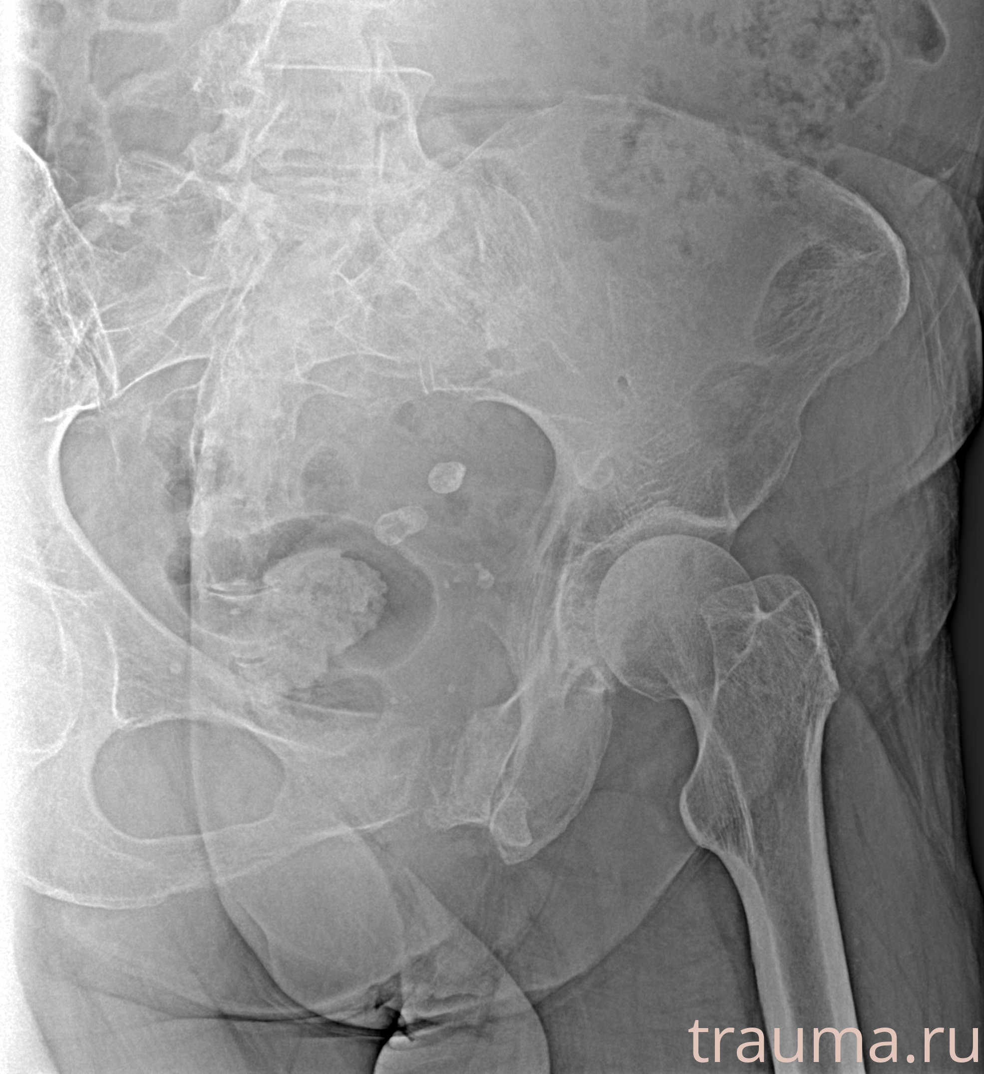 Рентген на дому: по вашему адресу приезжает врач-рентгенолог, травматолог-ортопед с мобильным рентгеновским аппаратом, проводит диагностику травмы или заболевания, делает необходимые рентгенограммы, дает рекомендации по дальнейшему лечению. Получить качественные снимки в домашних условиях возможно благодаря уникальной методике, разработанной МосРентген Центром для института  Склифосовского