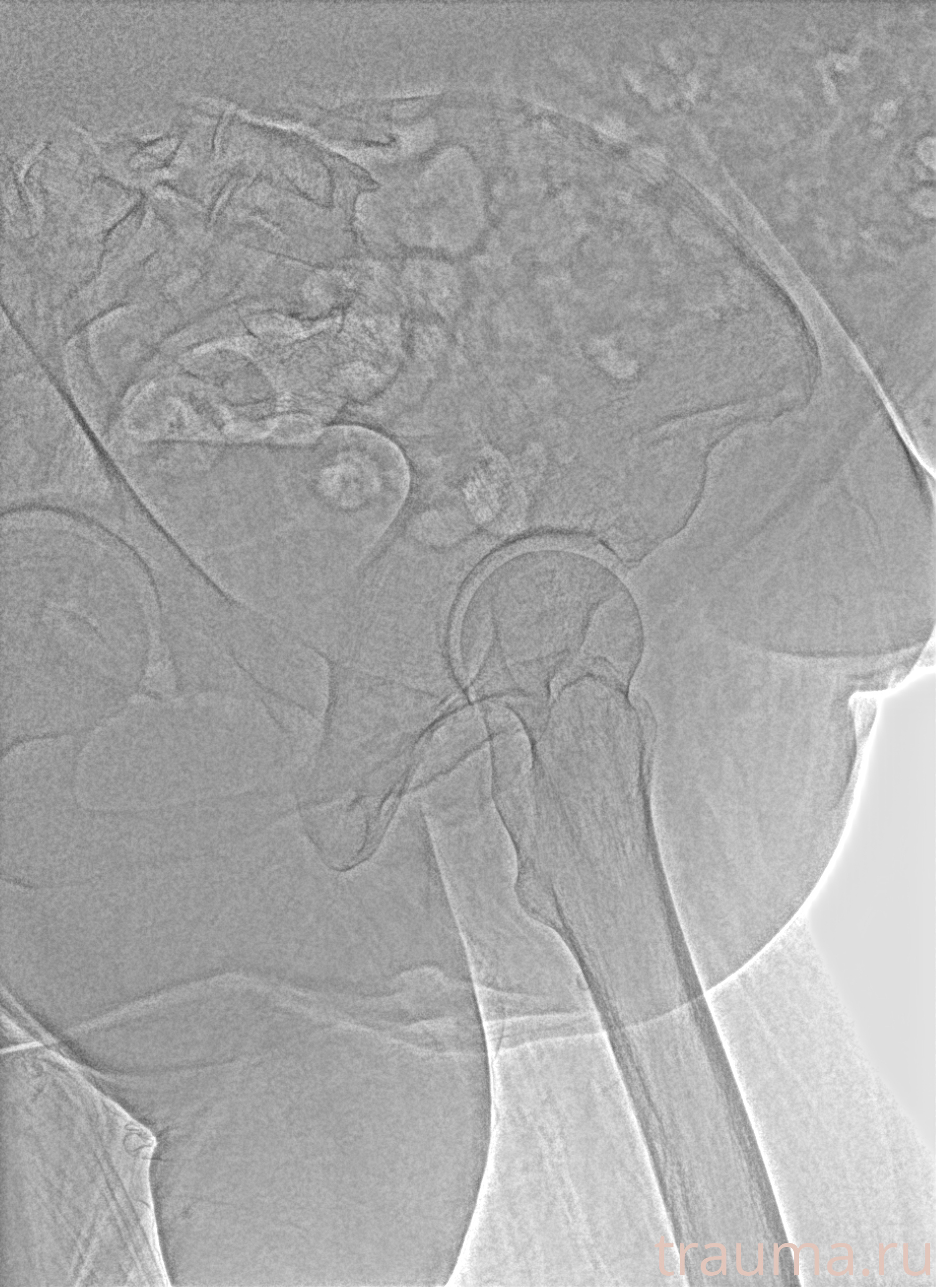 Рентген на дому: по вашему адресу приезжает врач-рентгенолог, травматолог-ортопед с мобильным рентгеновским аппаратом, проводит диагностику травмы или заболевания, делает необходимые рентгенограммы, дает рекомендации по дальнейшему лечению. Получить качественные снимки в домашних условиях возможно благодаря уникальной методике, разработанной МосРентген Центром для института  Склифосовского