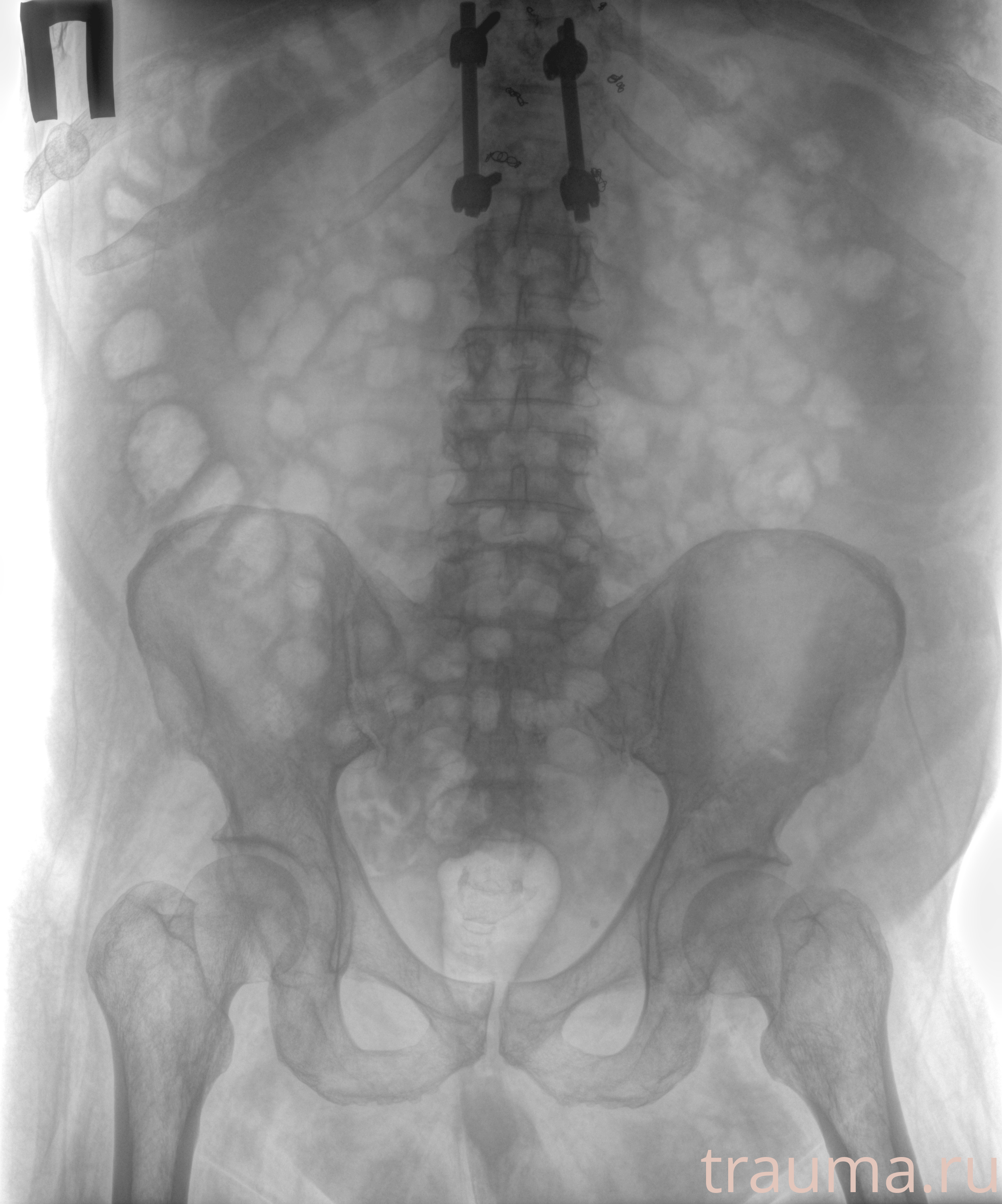 Рентген на дому: по вашему адресу приезжает врач-рентгенолог, травматолог-ортопед с мобильным рентгеновским аппаратом, проводит диагностику травмы или заболевания, делает необходимые рентгенограммы, дает рекомендации по дальнейшему лечению. Получить качественные снимки в домашних условиях возможно благодаря уникальной методике, разработанной МосРентген Центром для института  Склифосовского