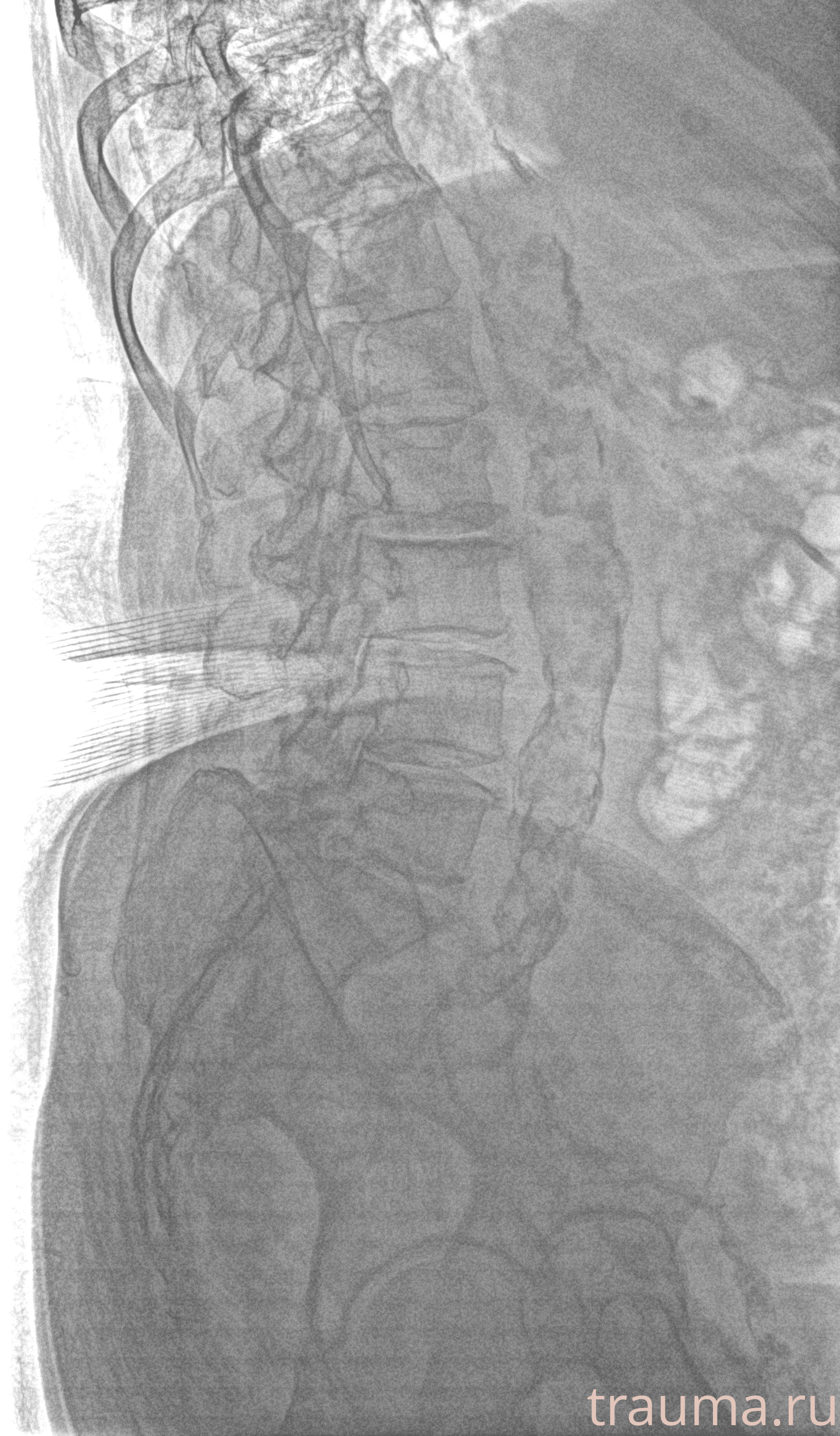 Рентген на дому: по вашему адресу приезжает врач-рентгенолог, травматолог-ортопед с мобильным рентгеновским аппаратом, проводит диагностику травмы или заболевания, делает необходимые рентгенограммы, дает рекомендации по дальнейшему лечению. Получить качественные снимки в домашних условиях возможно благодаря уникальной методике, разработанной МосРентген Центром для института  Склифосовского