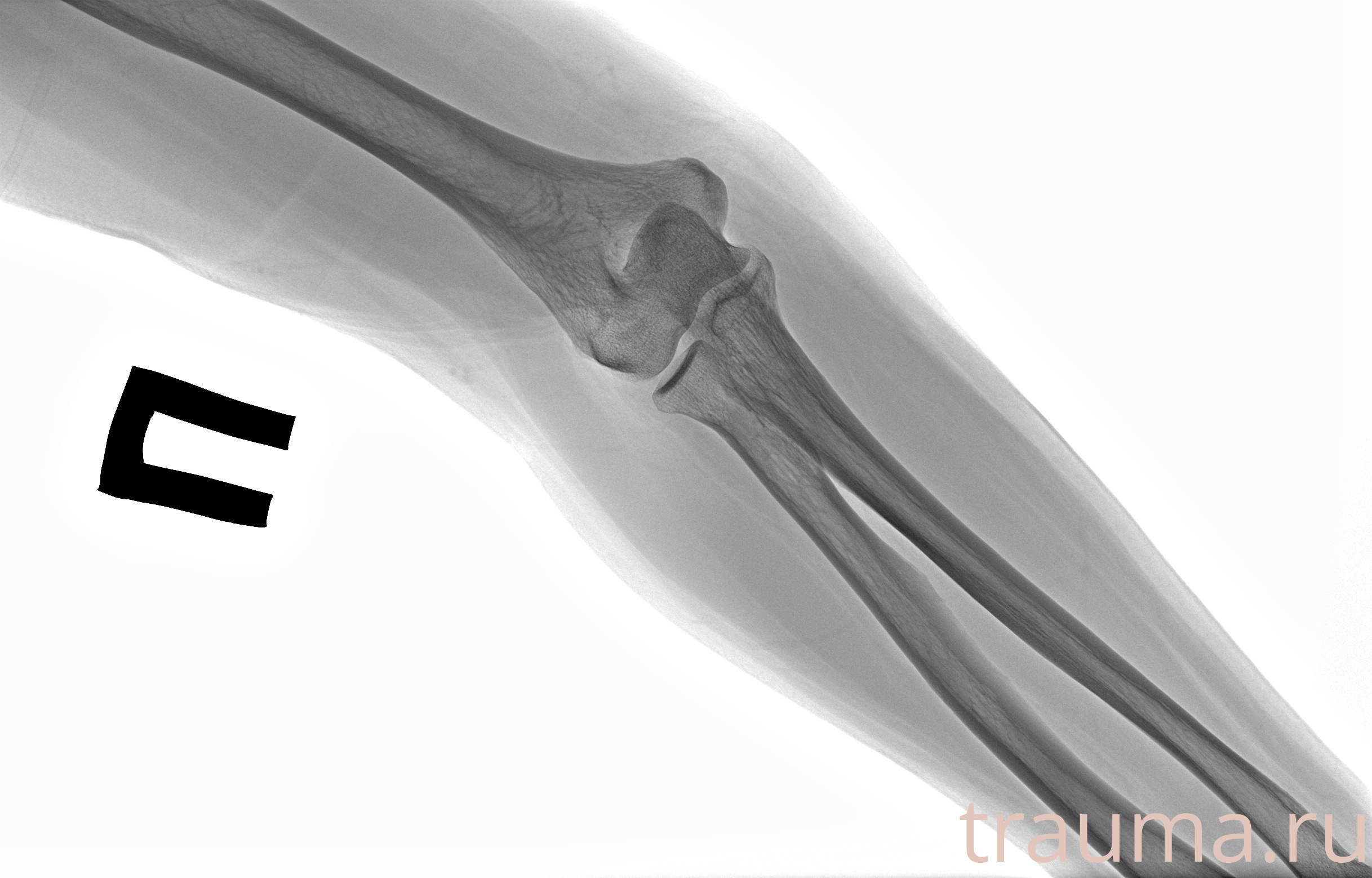 Рентген на дому: по вашему адресу приезжает врач-рентгенолог, травматолог-ортопед с мобильным рентгеновским аппаратом, проводит диагностику травмы или заболевания, делает необходимые рентгенограммы, дает рекомендации по дальнейшему лечению. Получить качественные снимки в домашних условиях возможно благодаря уникальной методике, разработанной МосРентген Центром для института  Склифосовского