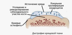 Ремоделирование субхондральной кости и неоангиогенез при декомпенсированной форме остеоартрита: эволюция терапевтического таргетирования Ремоделирование субхондральной кости и неоангиогенез при декомпенсированной форме остеоартрита: эволюция терапевтического таргетирования