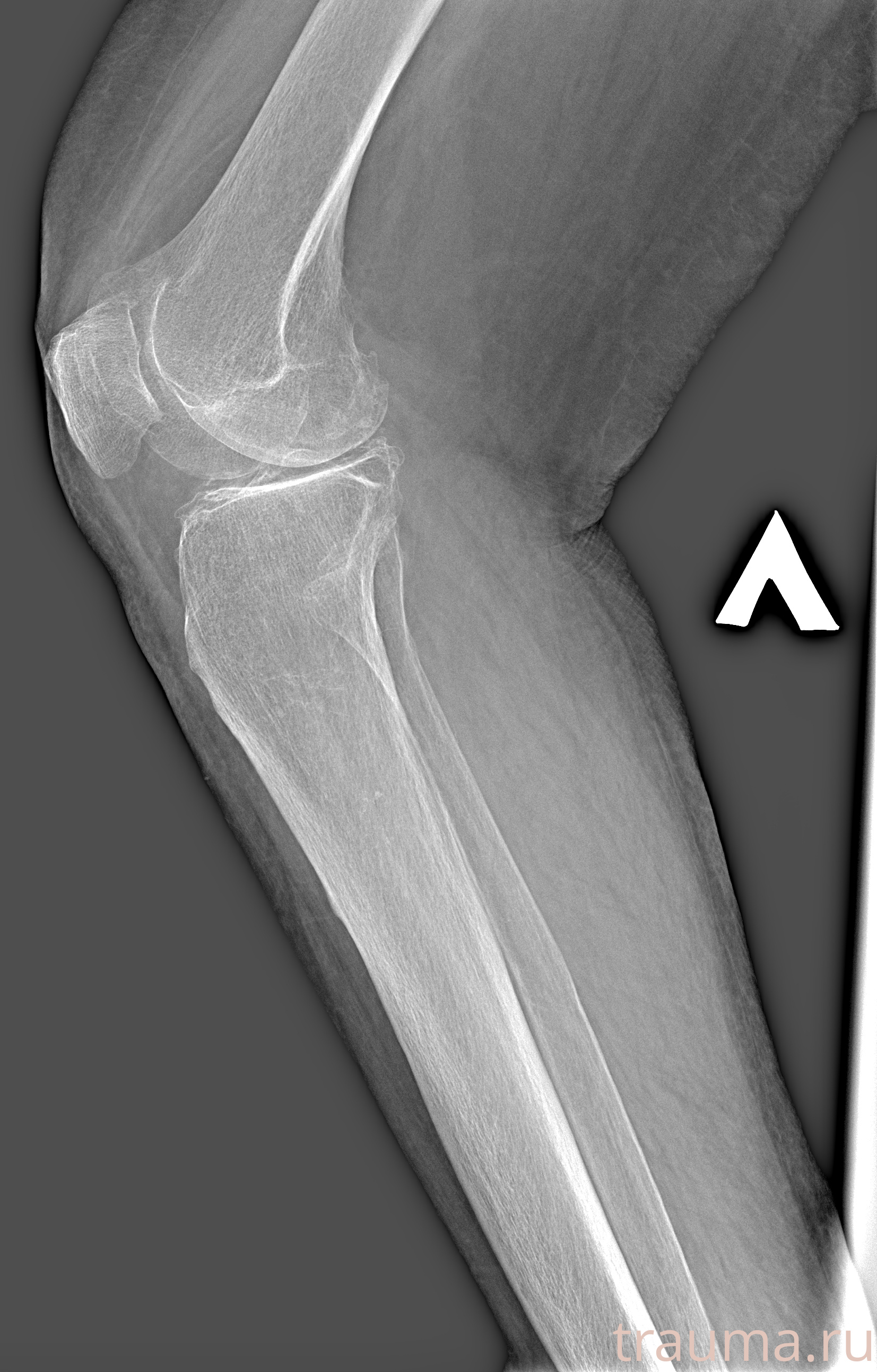 Рентген на дому: по вашему адресу приезжает врач-рентгенолог, травматолог-ортопед с мобильным рентгеновским аппаратом, проводит диагностику травмы или заболевания, делает необходимые рентгенограммы, дает рекомендации по дальнейшему лечению. Получить качественные снимки в домашних условиях возможно благодаря уникальной методике, разработанной МосРентген Центром для института  Склифосовского