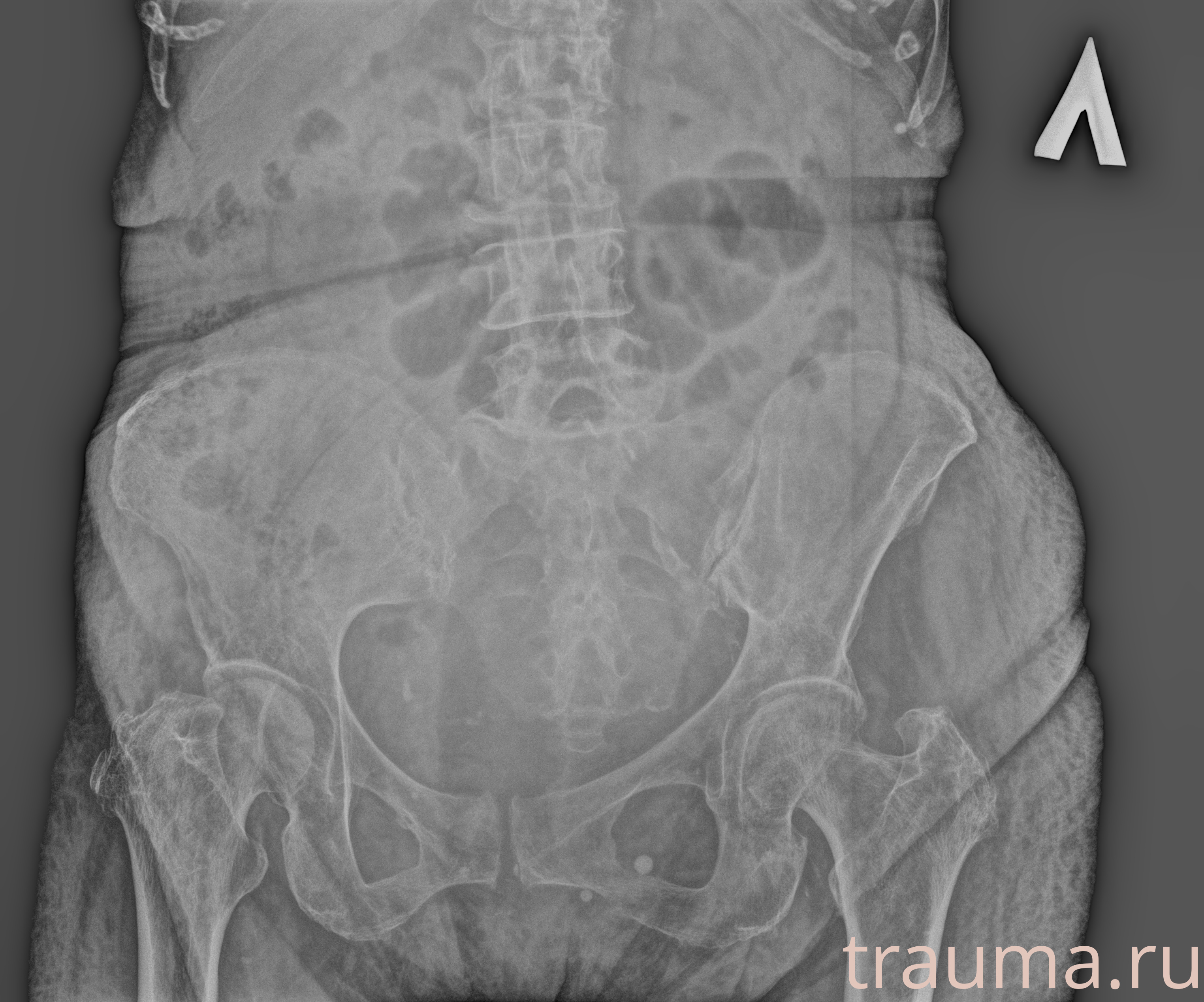 Рентген на дому: по вашему адресу приезжает врач-рентгенолог, травматолог-ортопед с мобильным рентгеновским аппаратом, проводит диагностику травмы или заболевания, делает необходимые рентгенограммы, дает рекомендации по дальнейшему лечению. Получить качественные снимки в домашних условиях возможно благодаря уникальной методике, разработанной МосРентген Центром для института  Склифосовского