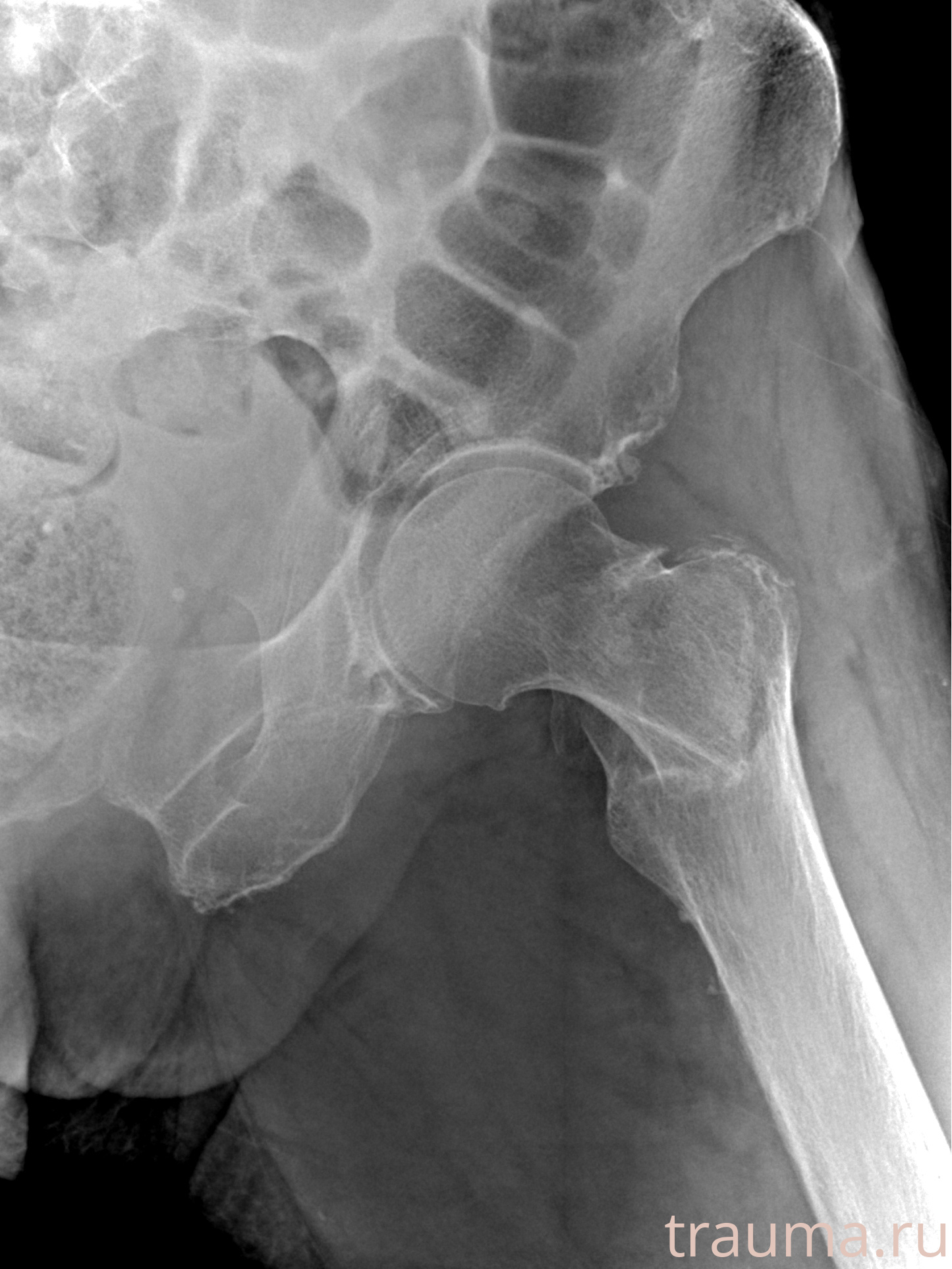 Рентген на дому: по вашему адресу приезжает врач-рентгенолог, травматолог-ортопед с мобильным рентгеновским аппаратом, проводит диагностику травмы или заболевания, делает необходимые рентгенограммы, дает рекомендации по дальнейшему лечению. Получить качественные снимки в домашних условиях возможно благодаря уникальной методике, разработанной МосРентген Центром для института  Склифосовского