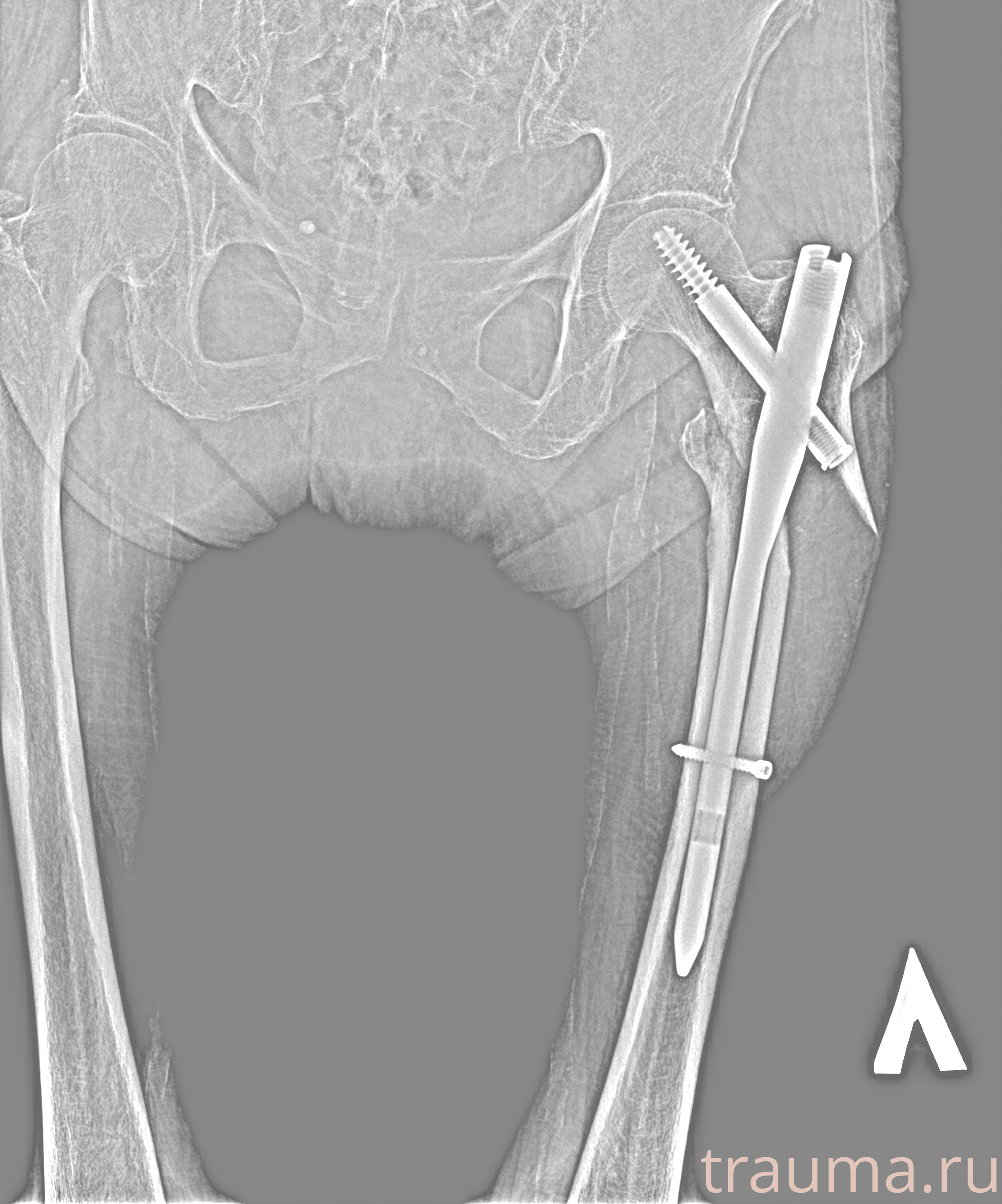 Рентген на дому: по вашему адресу приезжает врач-рентгенолог, травматолог-ортопед с мобильным рентгеновским аппаратом, проводит диагностику травмы или заболевания, делает необходимые рентгенограммы, дает рекомендации по дальнейшему лечению. Получить качественные снимки в домашних условиях возможно благодаря уникальной методике, разработанной МосРентген Центром для института  Склифосовского