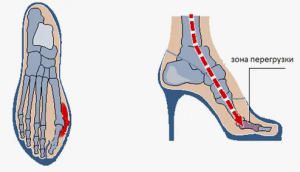 Влияние обуви с перекатной подошвой на распределение подошвенного давления у пациентов с остеоартритом первого плюснефалангового сустава