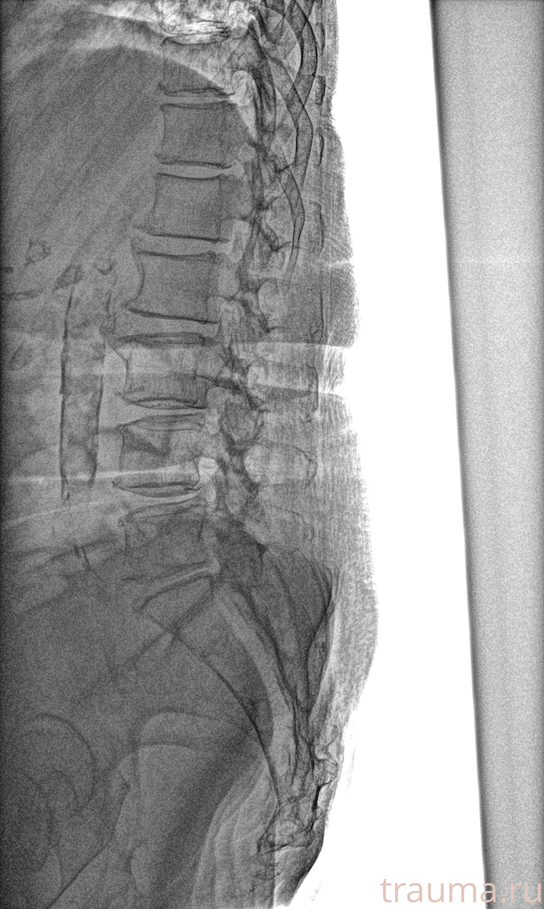 Рентген на дому: по вашему адресу приезжает врач-рентгенолог, травматолог-ортопед с мобильным рентгеновским аппаратом, проводит диагностику травмы или заболевания, делает необходимые рентгенограммы, дает рекомендации по дальнейшему лечению. Получить качественные снимки в домашних условиях возможно благодаря уникальной методике, разработанной МосРентген Центром для института  Склифосовского
