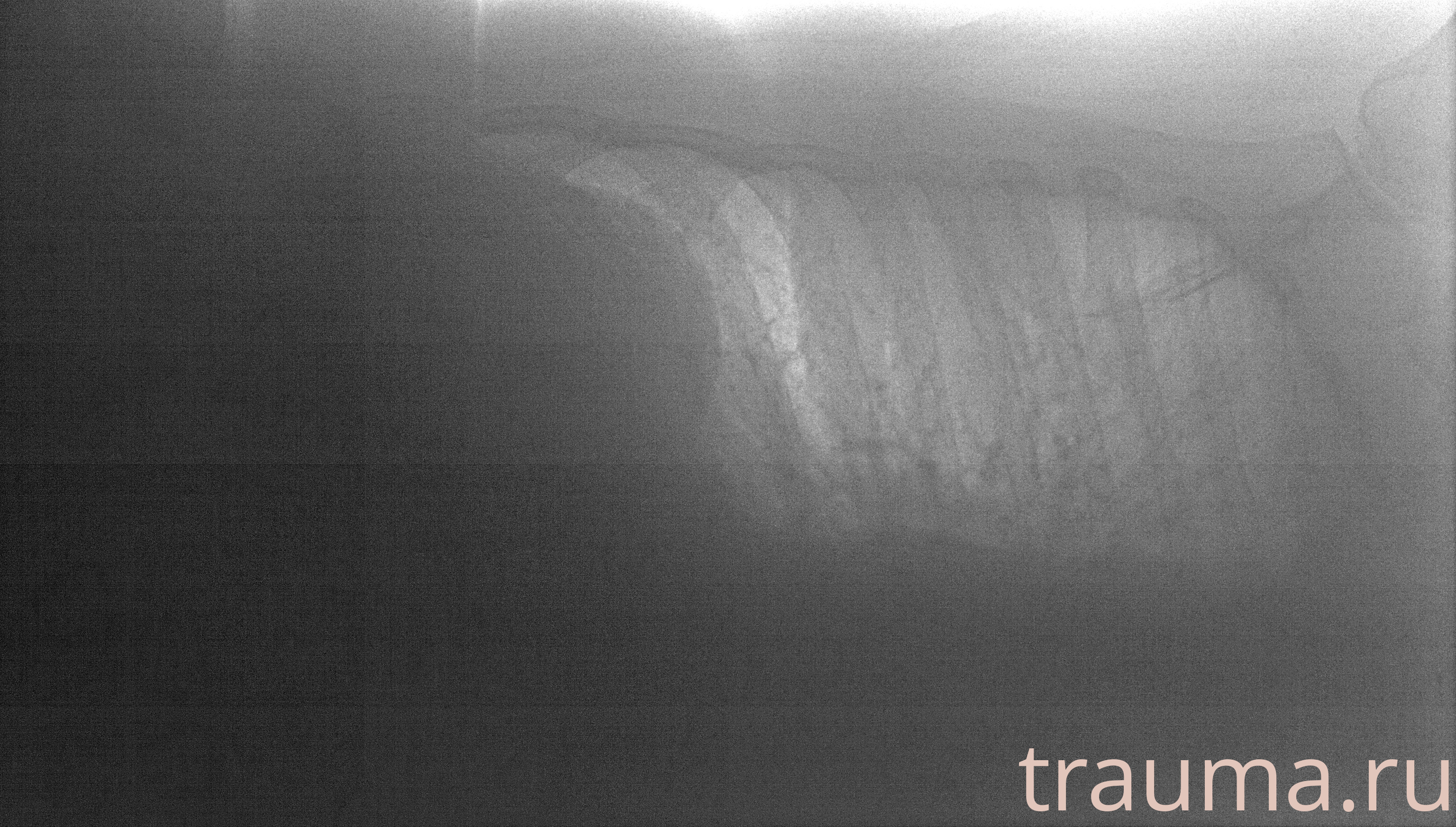 Рентген на дому: по вашему адресу приезжает врач-рентгенолог, травматолог-ортопед с мобильным рентгеновским аппаратом, проводит диагностику травмы или заболевания, делает необходимые рентгенограммы, дает рекомендации по дальнейшему лечению. Получить качественные снимки в домашних условиях возможно благодаря уникальной методике, разработанной МосРентген Центром для института  Склифосовского